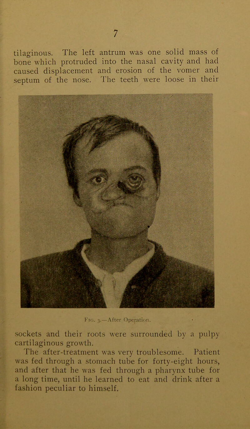 tilaginous. The left antrum was one solid mass of bone which protruded into the nasal cavity and had caused displacement and erosion of the vomer and septum of the nose. The teeth were loose in their Fig. 3.—After Operation. sockets and their roots were surrounded by a pulpy- cartilaginous growth. The after-treatment was very troublesome. Patient was fed through a stomach tube for forty-eight hours, and after that he was fed through a pharynx tube for a long time, until he learned to eat and drink after a fashion peculiar to himself.