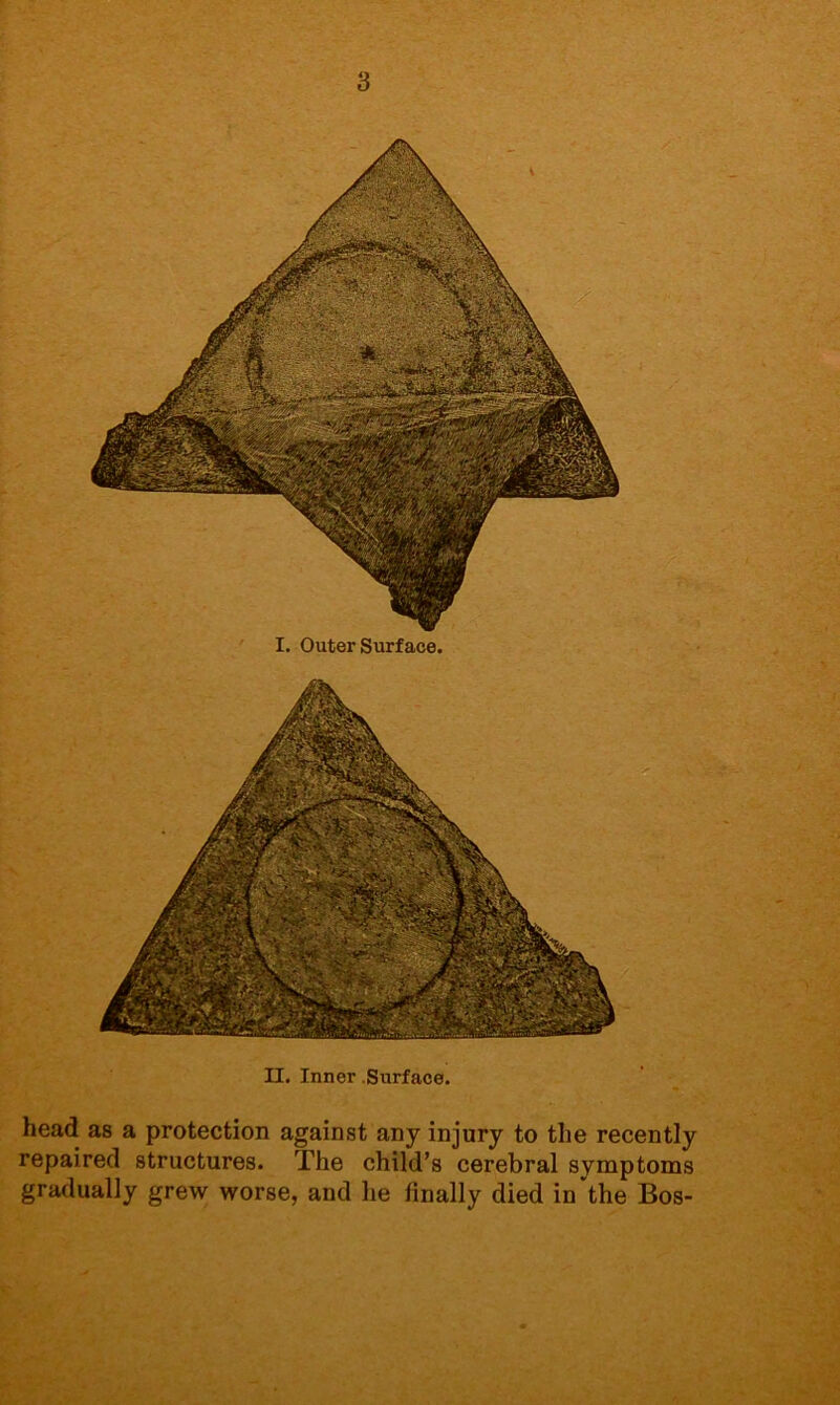 II. Inner Surface. head as a protection against any injury to the recently repaired structures. The child’s cerebral symptoms gradually grew worse, and he finally died in'the Bos- I. Outer Surf ace.