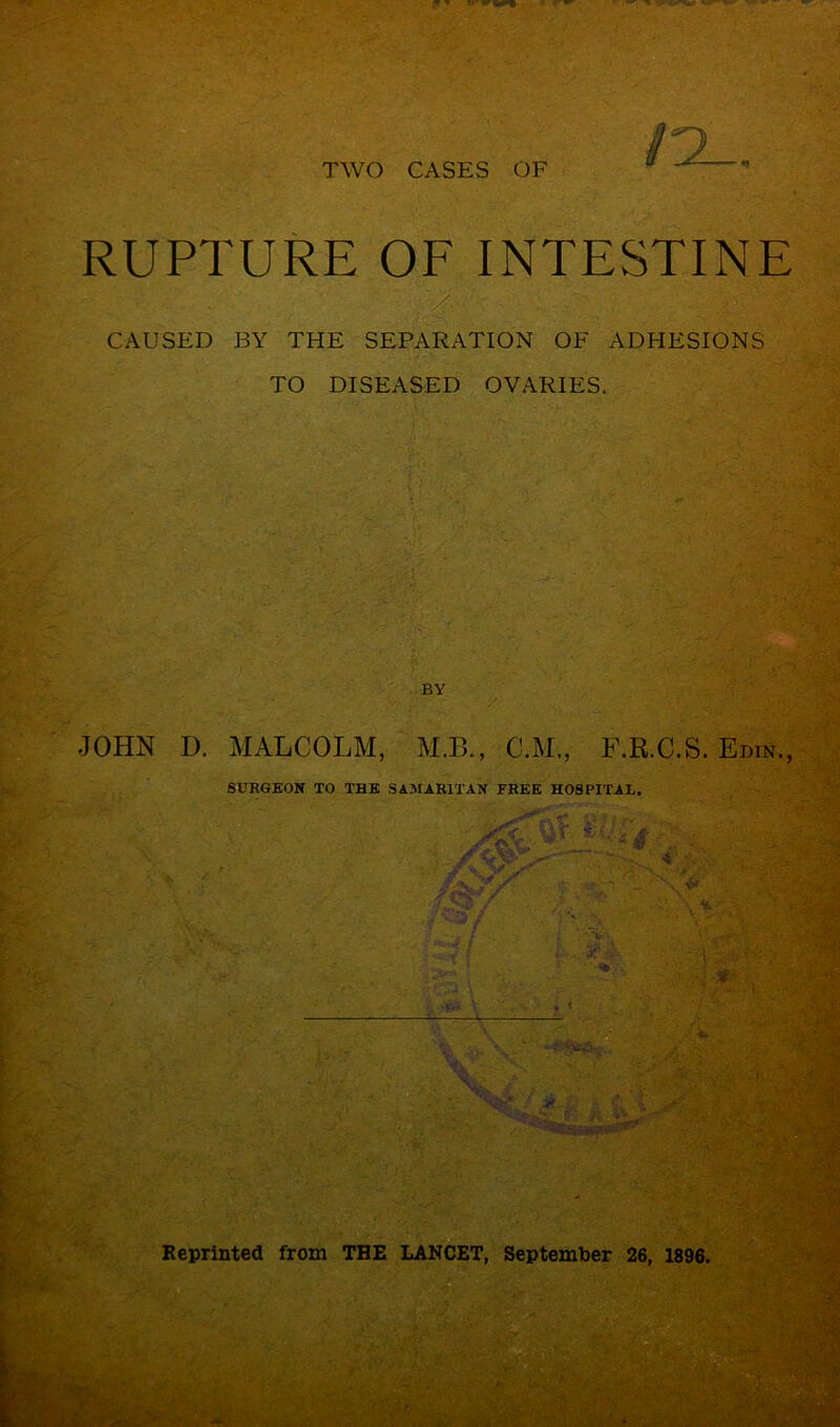 RUPTURE OF INTESTINE CAUSED BY THE SEPARATION OF ADHESIONS TO DISEASED OVARIES. JOHN D. MALCOLM, M.B., C.M., F.R.C.S. Edin., T— SURGEON TO THE SAMARITAN FREE HOSPITAL. V , r -