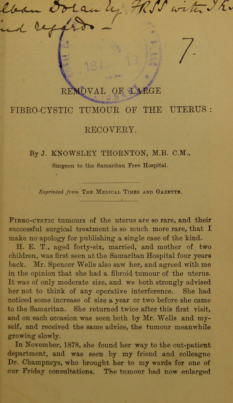 <TtrL , jfZyjf Ctrl' 7 x „ -i y REMOVAL OF LARGE FIBRO-CYSTIC TUMOUR OF THE UTERUS : RECOVERY. By J. KNOWSLEY THORNTON, M.B. C.M., Fibeo-ctstic tumours of the uterus are so rare, and their successful surgical treatment is so much more rare, that I make no apology for publishing a single case of the kind. H. E. T., aged forty-six, married, and mother of two children, was first seen at the Samaritan Hospital four years back. Mr. Spencer Wells also saw her, and agreed with me in the opinion that she had a fibroid tumour of the uterus. It was of only moderate size, and we both strongly advised her not to think of any operative interference. She had noticed some increase of size a year or two before she came to the Samaritan. She returned twice after this first visit, and on each occasion was seen both by Mr. Wells and my- self, and received the same advice, the tumour meanwhile growing slowly. In November, 1878, she found her way to the out-patient department, and was seen by my friend and colleague Dr. Champneys, who brought her to my wards for one of our Friday consultations. Tbe tumour had now enlarged Surgeon to the Samaritan Free Hospital. Reprinted from The Medical Times and Gazette.