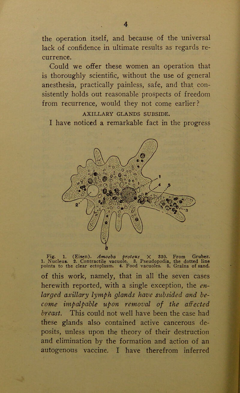 the operation itself, and because of the universal lack of confidence in ultimate results as regards re- currence. Could we offer these women an operation that is thoroughly scientific, without the use of general anesthesia, practically painless, safe, and that con- sistently holds out reasonable prospects of freedom from recurrence, would they not come earlier? AXILLARY GLANDS SUBSIDE. I have noticed a remarkable fact in the progress Fig. 1. (Eisen). Amoeba proteus X 330. From Gruber. 1. Nucleus. 2. Contractile vacuole. 3. Pseudopodia, the dotted line points to the clear ectoplasm. 4. Food vacuoles. 5. Grains of sand. of this work, namely, that in all the seven cases herewith reported, with a single exception, the en- larged axillary lymph glands have subsided and be- come impalpable upon removal of the affected breast. This could not well have been the case had these glands also contained active cancerous de- posits, unless upon the theory of their destruction and elimination by the formation and action of an autogenous vaccine. I have therefrom inferred