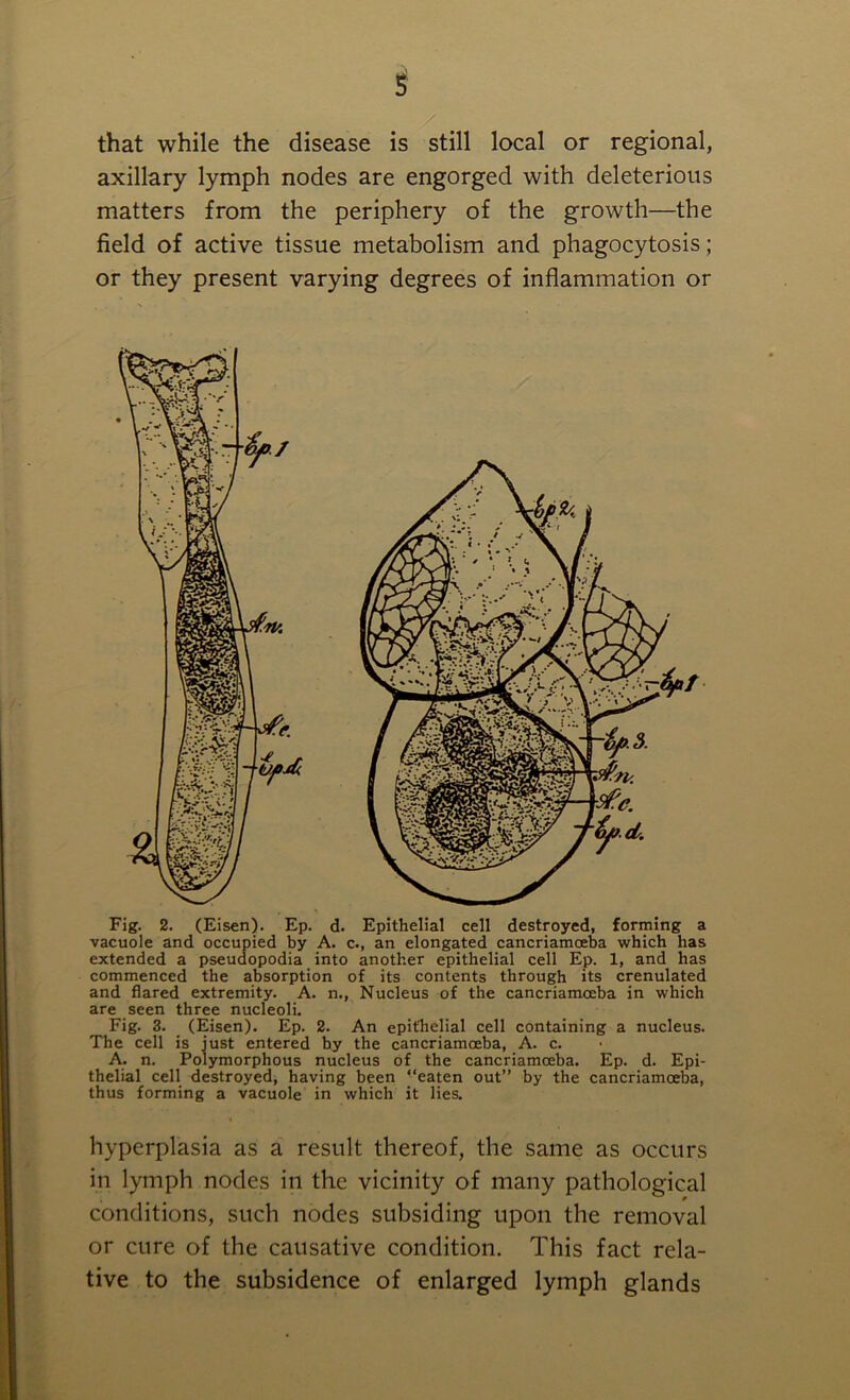 that while the disease is still local or regional, axillary lymph nodes are engorged with deleterious matters from the periphery of the growth—the field of active tissue metabolism and phagocytosis; or they present varying degrees of inflammation or Fig. 2. (Eisen). Ep. d. Epithelial cell destroyed, forming a vacuole and occupied by A. c., an elongated cancriamoeba which has extended a pseudopodia into another epithelial cell Ep. 1, and has commenced the absorption of its contents through its crenulated and flared extremity. A. n., Nucleus of the cancriamceba in which are seen three nucleoli. Fig. 3. (Eisen). Ep. 2. An epithelial cell containing a nucleus. The cell is just entered by the cancriamoeba, A. c. A. n. Polymorphous nucleus of the cancriamoeba. Ep. d. Epi- thelial cell destroyed, having been “eaten out” by the cancriamoeba, thus forming a vacuole in which it lies. hyperplasia as a result thereof, the same as occurs in lymph nodes in the vicinity of many pathological conditions, such nodes subsiding upon the removal or cure of the causative condition. This fact rela- tive to the subsidence of enlarged lymph glands