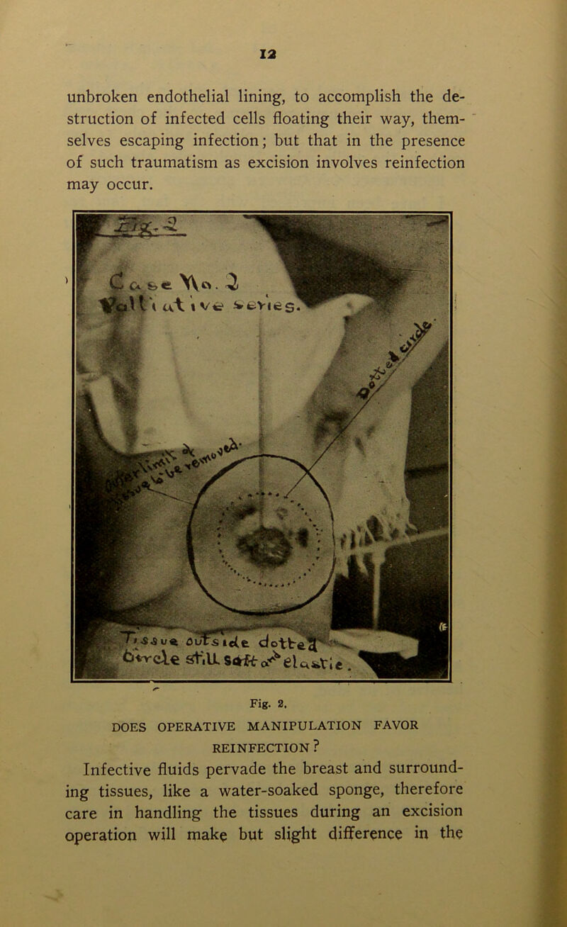 unbroken endothelial lining, to accomplish the de- struction of infected cells floating their way, them- selves escaping infection; but that in the presence of such traumatism as excision involves reinfection may occur. ''-s-s outs\ete dotted st-'.U. Fig. 2. DOES OPERATIVE MANIPULATION FAVOR REINFECTION ? Infective fluids pervade the breast and surround- ing tissues, like a water-soaked sponge, therefore care in handling the tissues during an excision operation will make but slight difference in the