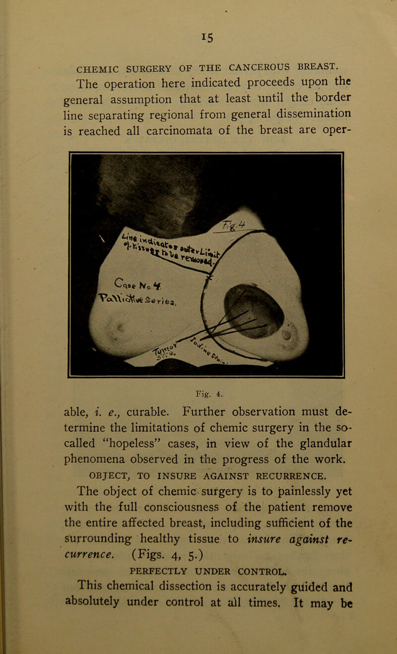 CHEMIC SURGERY OF THE CANCEROUS BREAST. The operation here indicated proceeds upon the general assumption that at least until the border line separating regional from general dissemination is reached all carcinomata of the breast are oper- Fig. 4. able, i. e., curable. Further observation must de- termine the limitations of chemic surgery in the so- called “hopeless” cases, in view of the glandular phenomena observed in the progress of the work. OBJECT, TO INSURE AGAINST RECURRENCE. The object of chemic surgery is to painlessly yet with the full consciousness of the patient remove the entire affected breast, including sufficient of the surrounding healthy tissue to insure against re- currence. (Figs. 4, 5.) PERFECTLY UNDER CONTROL. This chemical dissection is accurately guided and absolutely under control at all times. It may be