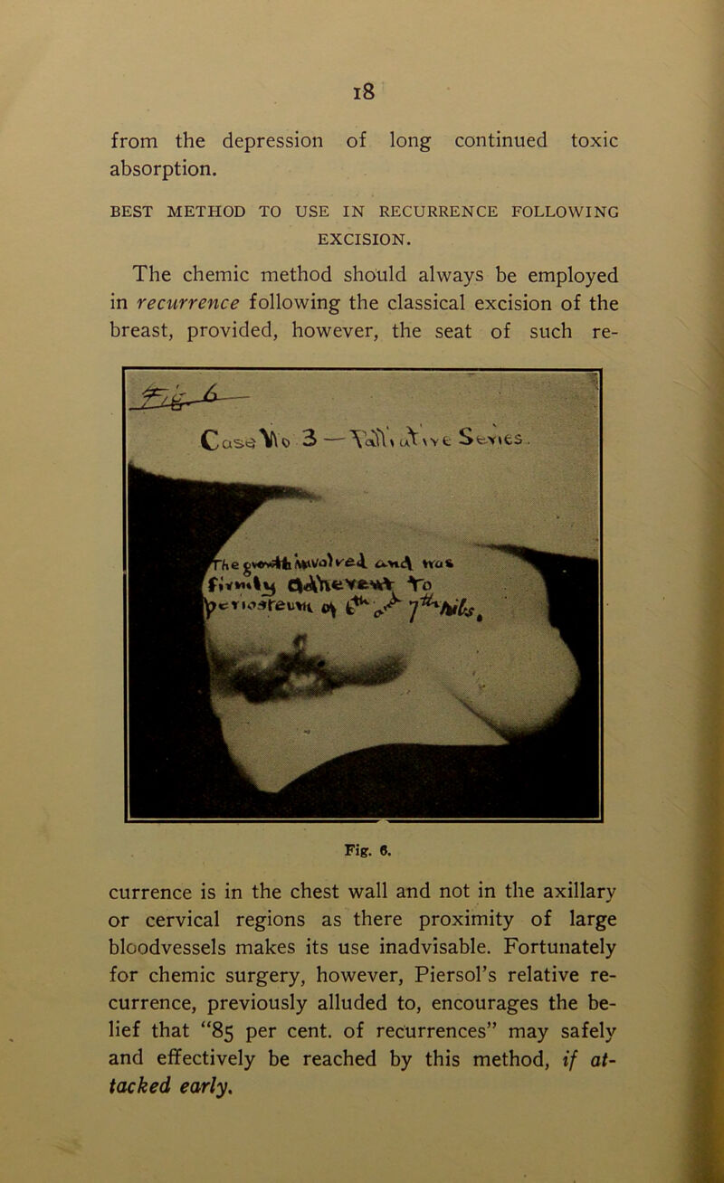 from the depression of long continued toxic absorption. BEST METHOD TO USE IN RECURRENCE FOLLOWING EXCISION. The chemic method should always be employed in recurrence following the classical excision of the breast, provided, however, the seat of such re- Fig. 6. currence is in the chest wall and not in the axillary or cervical regions as there proximity of large bloodvessels makes its use inadvisable. Fortunately for chemic surgery, however, Piersol’s relative re- currence, previously alluded to, encourages the be- lief that “85 per cent, of recurrences” may safely and effectively be reached by this method, if at- tacked early.