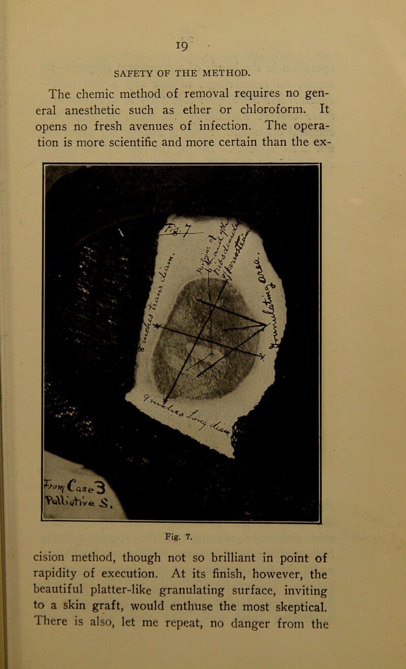 SAFETY OF THE METHOD. The chemic method of removal requires no gen- eral anesthetic such as ether or chloroform. It opens no fresh avenues of infection. The opera- tion is more scientific and more certain than the ex- Fig. 7. cision method, though not so brilliant in point of rapidity of execution. At its finish, however, the beautiful platter-like granulating surface, inviting to a skin graft, would enthuse the most skeptical. There is also, let me repeat, no danger from the