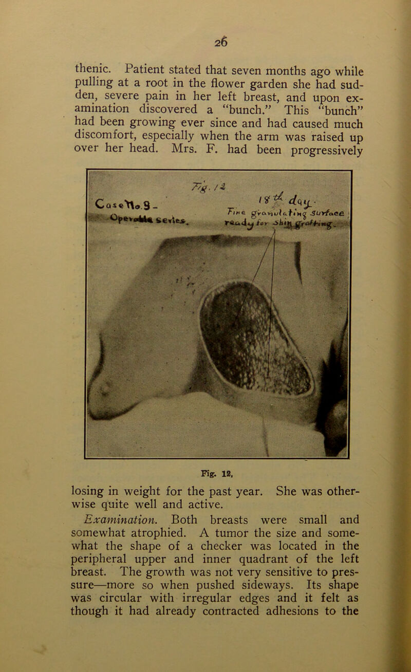 thenic. Patient stated that seven months ago while pulling at a root in the flower garden she had sud- den, severe pain in her left breast, and upon ex- amination discovered a “bunch.” This “bunch” had been growing ever since and had caused much discomfort, especially when the arm was raised up over her head. Mrs. F. had been progressively Fig. 12, losing in weight for the past year. She was other- wise quite well and active. Examination. Both breasts were small and somewhat atrophied. A tumor the size and some- what the shape of a checker was located in the peripheral upper and inner quadrant of the left breast. The growth was not very sensitive to pres- sure—more so when pushed sideways. Its shape was circular with irregular edges and it felt as though it had already contracted adhesions to the