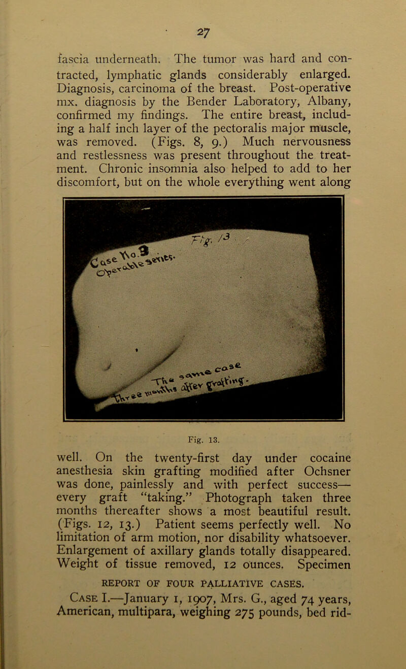 fascia underneath. The tumor was hard and con- tracted, lymphatic glands considerably enlarged. Diagnosis, carcinoma of the breast. Post-operative mx. diagnosis by the Bender Laboratory, Albany, confirmed my findings. The entire breast, includ- ing a half inch layer of the pectoralis major muscle, was removed. (Figs. 8, 9.) Much nervousness and restlessness was present throughout the treat- ment. Chronic insomnia also helped to add to her discomfort, but on the whole everything went along Fig. 13. well. On the twenty-first day under cocaine anesthesia skin grafting modified after Ochsner was done, painlessly and with perfect success— every graft “taking.” Photograph taken three months thereafter shows a most beautiful result. (Figs. 12, 13.) Patient seems perfectly well. No limitation of arm motion, nor disability whatsoever. Enlargement of axillary glands totally disappeared. Weight of tissue removed, 12 ounces. Specimen REPORT OF FOUR PALLIATIVE CASES. Case I.—January 1, 1907, Mrs. G., aged 74 years, American, multipara, weighing 275 pounds, bed rid-