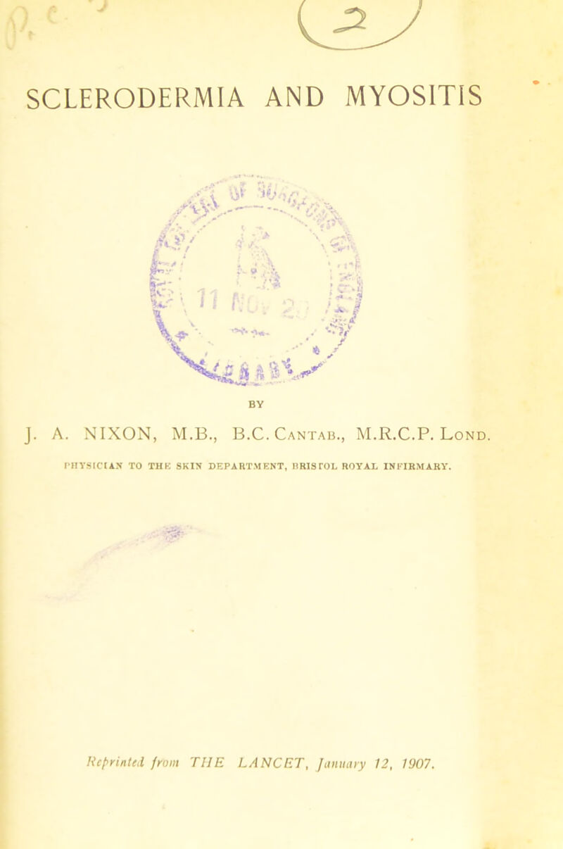 SCLERODERMIA AND MYOSITIS J. A. NIXON, M.B., B.C. Cantab., M.R.C.P. Lond. PHYSICIAN TO THE SKIN DEPARTMENT, BRISTOL ROYAL INFIRMARY’. :'5*' Reprinted from THE LANCET, January 12, 1907.