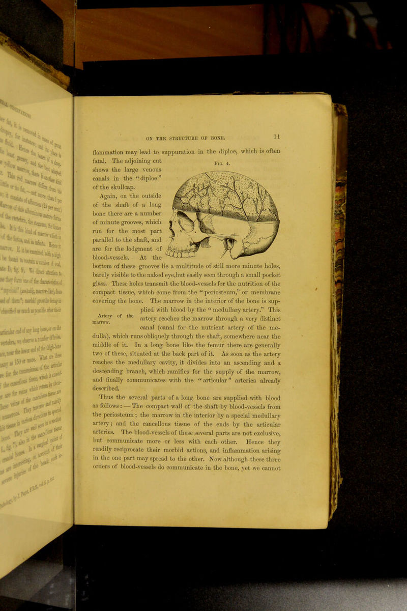 11 Fia. 4. flammation may lead to suppuration in the diploe, which is often fatal. The adjoining cut shows the large venous canals in the diploe of the skullcap. Again, on the outside of the shaft of a long bone there are a number of minute grooves, which run for the most part parallel to the shaft, and are for the lodgment of blood-vessels. At the bottom of these grooves lie a multitude of still more minute holes, barely visible to the naked eye,but easily seen through a small pocket glass. These holes transmit the blood-vessels for the nutrition of the compact tissue, which come from the  periosteum, or membrane covering the bone. The marrow in the interior of the bone is sup- plied with blood by the  medullary artery. This artery reaches the marrow through a very distinct canal (canal for the nutrient artery of the me- dulla), which runs obliquely through the shaft, somewhere near the middle of it. In a long bone like the femur there are generally two of these, situated at the back part of it. As soon as the artery reaches the medullary cavity, it divides into an ascending and a descending branch, which ramifies for the supply of the marrow, and finally communicates with the articular arteries already described. Thus the several parts of a long bone are supplied with blood as follows : — The compact wall of the shaft by blood-vessels from the periosteum ; the marrow in the interior by a special medullary artery; and the cancellous tissue of the ends by the articular arteries. The blood-vessels of these several parts are not exclusive, but communicate more or less with each other. Hence they readily reciprocate their morbid actions, and inflammation arising in the one part may spread to the other. Now although these three orders of blood-vessels do communicate in the bone, yet we cannot Artery- marrow. of the