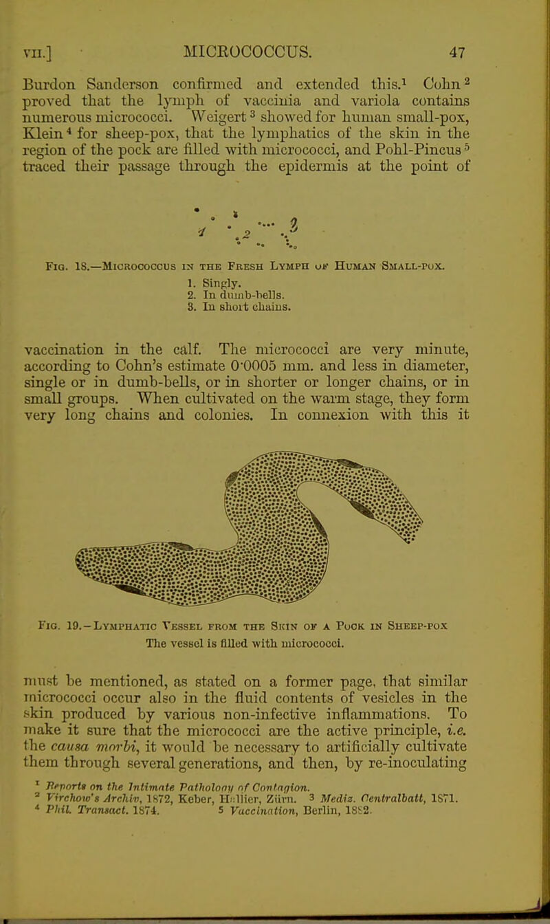 Burdon Sanderson confirmed and extended this.^ Culin^ proved that the lymph of vaccinia and variola contains numerous micrococci. Weigert ^ showed for human small-pox, Klein* for sheep-pox, that the lymphatics of the skin in the region of the pock are filled with micrococci, and Pohl-Pincus ^ traced their passage through the epidermis at the point of Fig. 18.—Micrococcus in the Fresh Lymph oif Hui^an Small-pux. 1. Singly. 2. In duiiib-Viells. 3. In shoit chains. vaccination in the calf. The micrococci are very minute, according to Cohn's estimate O'OOOS mm. and less in diameter, single or in dumb-bells, or in shorter or longer chains, or in small groups. When cultivated on the warm stage, they form very long chains and colonies. In connexion with this it Fig. 19. —Lymphatic Vessel from the Skin of a Puck in Sheep-pox The vessel is filled with micrococci. must be mentioned, as stated on a former page, that similar micrococci occur also in the fluid contents of vesicles in the f-kin produced by various non-infective inflammations. To make it sure that the micrococci are the active principle, i.e. the causa morhi, it would be necessary to artificially cultivate them through several generations, and then, by re-inoculating ' jRfporta on th/i Intimate Patlwlony of Contagion. ' Virchow'g Archlv, 1872, Keber, H.iliier, Ziivn. 3 Mediz. Centralbatt, 1S71. * Phil. Transact. 1S74. 5 Vaccination, Berlin, 18S2.