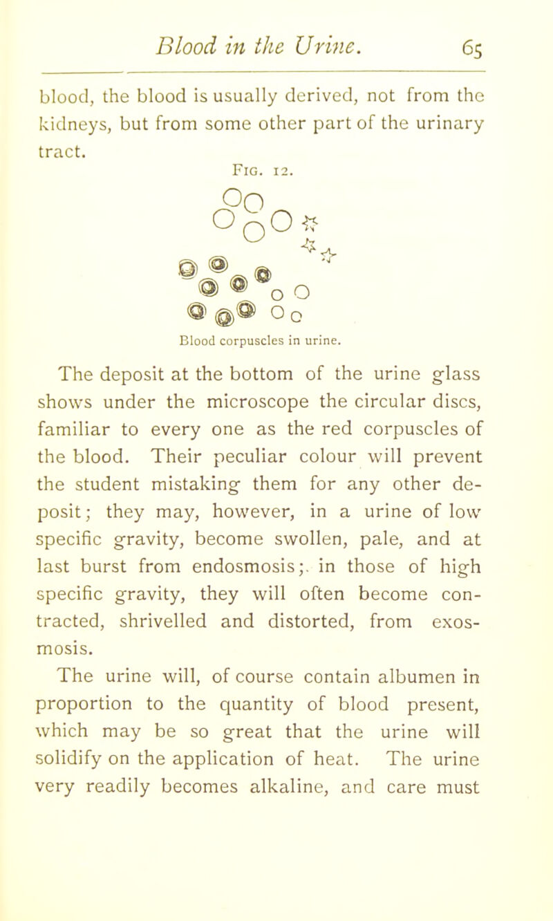 blood, the blood is usually derived, not from the kidneys, but from some other part of the urinary tract. Fig. 12. ^ @ ® o o Blood corpuscles in urine. The deposit at the bottom of the urine glass shows under the microscope the circular discs, familiar to every one as the red corpuscles of the blood. Their peculiar colour will prevent the student mistaking- them for any other de- posit ; they may, however, in a urine of low specific gravity, become swollen, pale, and at last burst from endosmosis;. in those of high specific gravity, they will often become con- tracted, shrivelled and distorted, from exos- mosis. The urine will, of course contain albumen in proportion to the quantity of blood present, which may be so great that the urine will solidify on the application of heat. The urine very readily becomes alkaline, and care must
