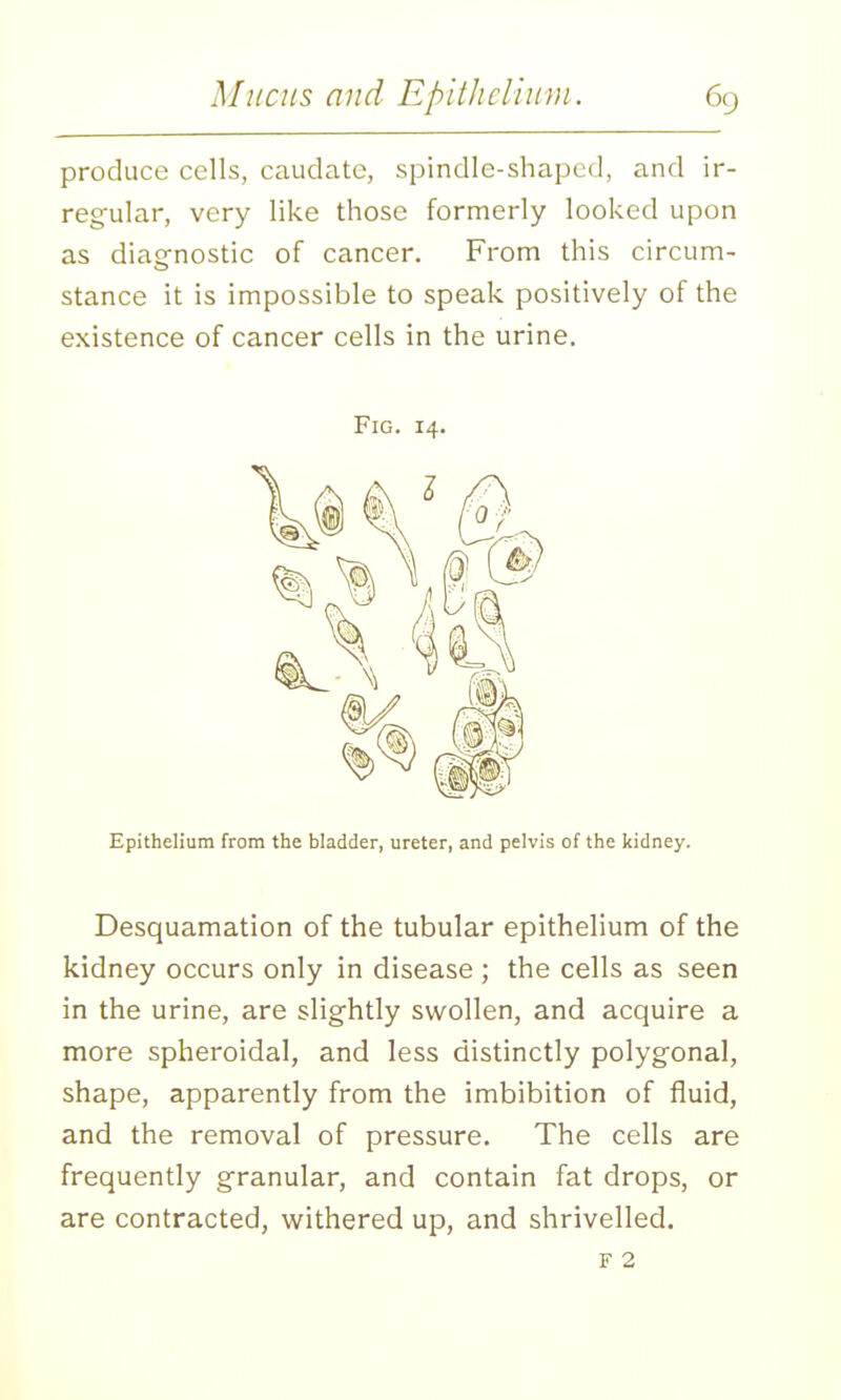 produce cells, caudate, spindle-shaped, and ir- regular, very like those formerly looked upon as diag-nostic of cancer. From this circum- stance it is impossible to speak positively of the existence of cancer cells in the urine. Fig. 14. Epithelium from the bladder, ureter, and pelvis of the kidney. Desquamation of the tubular epithelium of the kidney occurs only in disease ; the cells as seen in the urine, are slightly swollen, and acquire a more spheroidal, and less distinctly polygonal, shape, apparently from the imbibition of fluid, and the removal of pressure. The cells are frequently granular, and contain fat drops, or are contracted, vi^ithered up, and shrivelled. F 2