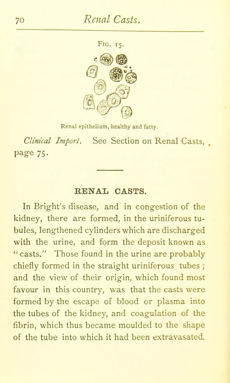 Fig. 15. Renal epithelium, healthy and fatty. Clinical Imparl. See Section on Renal Casts, page 75. RENAL CASTS. In Brig-ht's disease, and in congestion of the kidney, there are formed, in the uriniferous tu- bules, lengthened cylinders which are discharg-ed with the urine, and form the deposit known as  casts. Those found in the urine are probably chiefly formed in the straight uriniferous tubes ; and the view of their origin, which found most favour in this country, was that the casts were formed by the escape of blood or plasma into the tubes of the kidney, and coagulation of the fibrin, which thus became moulded to the shape of the tube into which it had been extravasated.