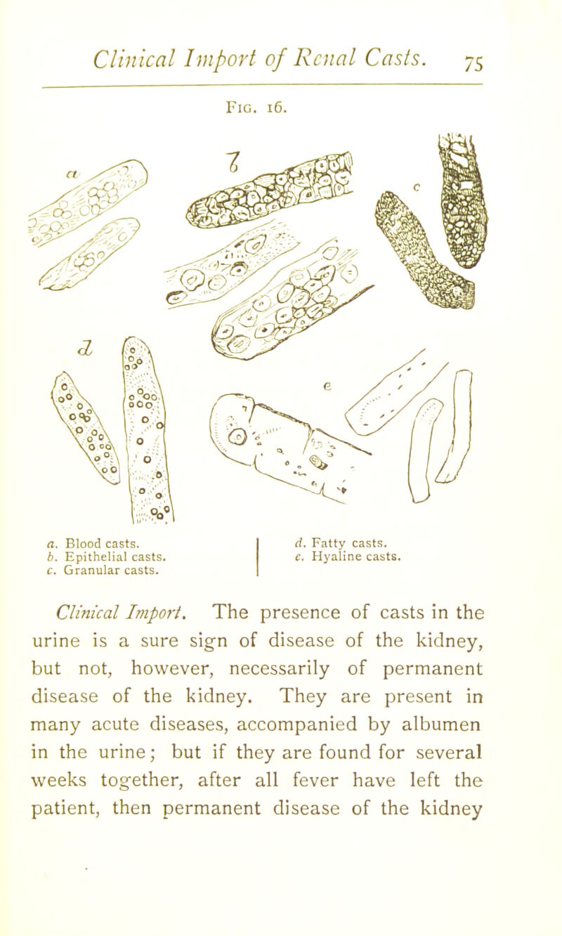 Fig. 16. a. Blood casts. b. Epithelial casts. c. Granular casts. d. Fatty casts. c. Hyaline casts. Clinical Import. The presence of casts in the urine is a sure sign of disease of the kidney, but not, however, necessarily of permanent disease of the kidney. They are present in many acute diseases, accompanied by albumen in the urine; but if they are found for several weeks together, after all fever have left the patient, then permanent disease of the kidney