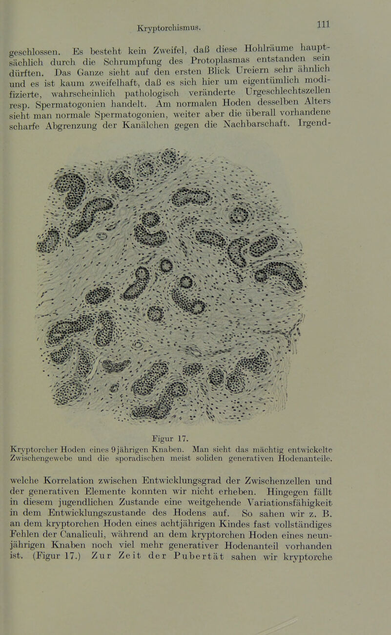 geschlossen. Es besteht kein Zweifel, daß diese Hohlräume haupt- sächlich durch die Schrumpfung des Protoplasmas entstanden sein dürften. Das Ganze sieht auf den ersten Blick Ureiem sehr ähnlich und es ist kaum zweifelhaft, daß es sich hier um eigentümlich modi- fizierte, wahrscheinlich pathologisch veränderte Urgeschlechtszellen resp. Sperniatogonien handelt. Am normalen Hoden desselben Alters sieht man normale Spermatogonien, weiter aber die überall vorhandene scharfe Abgrenzung der Kanälchen gegen die Nachbarschaft. Irgend- Figur 17. Kryptorcher Hoden eines 9 jährigen Klnaben. Man sieht das mächtig entwickelte Zwischengewebe und die sporadischen meist sohden generativen Hodenanteile. welche Korrelation zwischen Entwicklungsgrad der Zwischenzellen und der generativen Elemente konnten wir nicht erheben. Hingegen fällt in diesem jugendlichen Zustande eine weitgehende Variationsfähigkeit in dem Entwicklungszustande des Hodens auf. So sahen wir z. B. an dem kryptorchen Hoden eines achtjährigen Kindes fast vollständiges Fehlen der CanaHculi, während an dem kryptorchen Hoden eines neun- jährigen Knaben noch viel mehr generativer Hodenanteil vorhanden ist. (Figur 17.) Zur Zeit der Pubertät sahen wir kryptorche