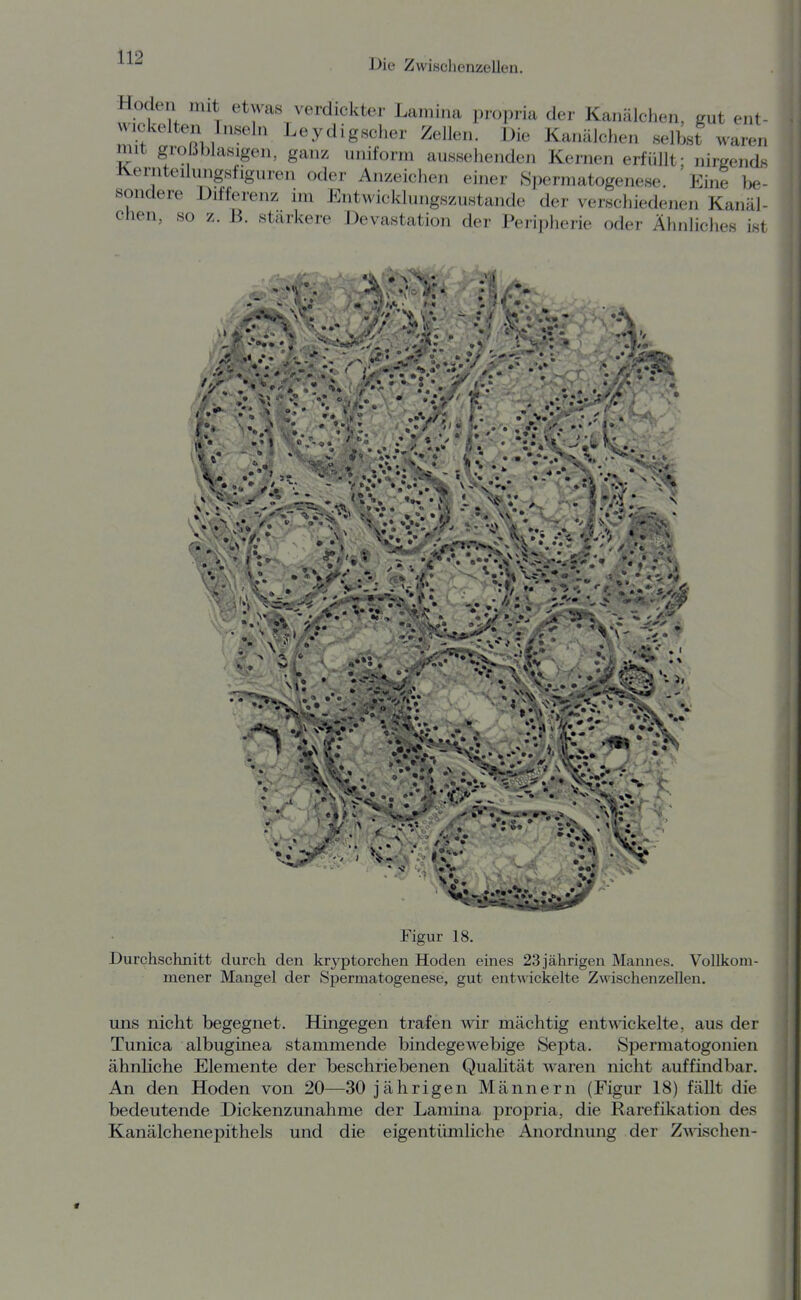 Die Zwischenzellen. Hoden nut etwas verdickter Laniirux propria der Kanälchen, gut ent- wickelten Inseln Leydigscher Zellen. Die Kanälchen selbst waren mit groüblasigen, ganz uniform aussehenden Kernen erfüllt; nirgendi^ Kernteilungsfiguren oder Anzeichen einer Spermatogenese. Eine ])e- sondere Differenz im Entwicklungszustande der verschiedenen Kanäl- chen, so z. B. stärkere Devastation der Peripherie oder Ähnliches ist *•»• Figur 18. Durchschnitt durch den kryptorchen Hoden eines 23 jährigen Mannes. Vollkom- mener Mangel der Spermatogenese, gut entw ickelte ZAvischenzellen. uns nicht begegnet. Hingegen trafen wir mächtig entwickelte, aus der Tunica albuginea stammende bindegewebige Septa. Spermatogonien ähnliche Elemente der beschriebenen Qualität waren nicht auffindbar. An den Hoden von 20—30 jährigen Männern (Figur 18) fällt die bedeutende Dickenzunahme der Lamina propria, die Rarefikation des Kanälchenepithels und die eigentümliche Anordnung der Z^^^schen-