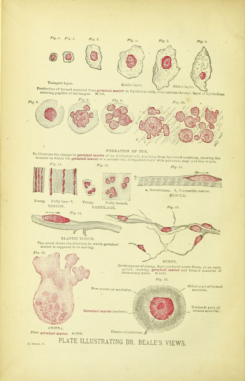 TouDgest layer. Middle layer Production of formert material from germinal matter Kg. n. Oldeit lay- covering papiU» of the tougue.''x70o; '° irom section througl, layer^piiheUmn FlO-S. Pig, ,0, Pit}- 10. FORMATION OF PUS. Fig. 13. Voung. Fully fonr-1. y„„ng. Fully ,armed. TJSMON. CARTILAGE. Pig. li. Fig. IS. ELASTIC TISSUE. Tlie arrow shows the direclinn in whlcli germinal malt*^r id ^supposed to be moving. NKRVK. Berelopment of yoanc, <iark-liordored nerve fibres, at an early IJCriod, showing germinal matter ajid formed uatfrial of eleniunlary parti*. XISOO. >rew centre or nucleoliw. G«rmin:il matter(Qiiolcus) Oldest part of forpie-l . ^ material. Vonnppst part of lormed material. Pimj germinal matter. X-snoo, Course of putiuluiii. PLATE ILLUSTRATING DR. BEALE'S VIEWS,