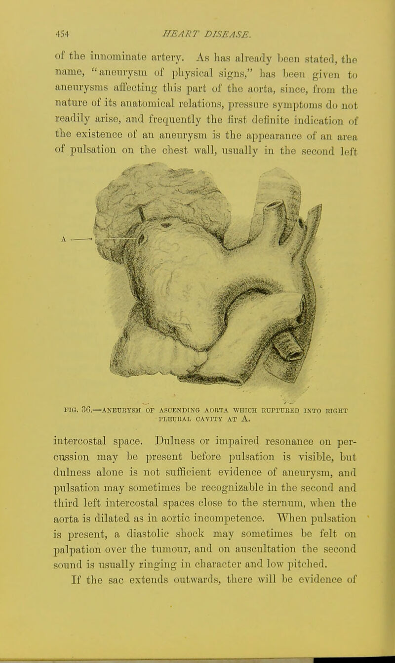 of the innoininato artery. As has already heeii stated, the name, ancurysin of physical sif^ns, lias been given to aneurysms affecting this part ol' the aorta, since, fi'om the nature of its anatomical relations, pressure symptoms do not readily arise, and frequently the first definite indication of the existence of an aneurysm is the appearance of an area of pulsation on tlie chest wall, usually in the second left PIG. 3G.—aneuhysm op ascending aobta which ruptuhed into right rLEDRAL CAVITV AT A. intercostal space. Dulness or impaired resonance on per- cussion may be present before pulsation is visible, but dulness alone is not sufficient evidence of aneurysm, and pulsation may sometimes be recognizable in the second and third left intercostal spaces close to the sternum, when the aorta is dilated as in aortic incompetence. When pulsation is present, a diastolic shock may sometimes be felt on palpation over the tumour, and on auscultation the second sound is usually ringing in character and low pitched. If the sac extends outwards, there will be evidence of