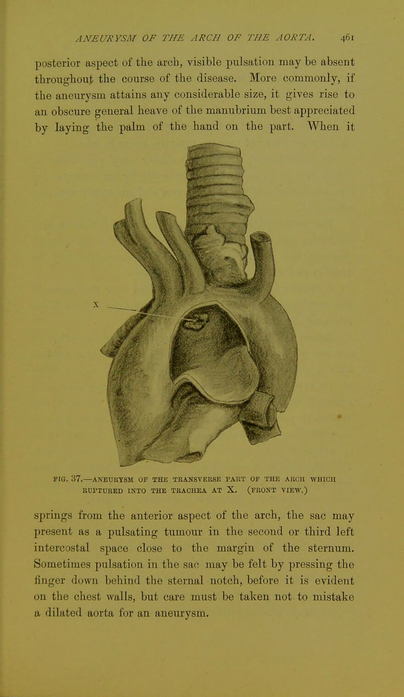 posterior aspect of the arch, visible pulsation may be absent throughout the course of the disease. More commonly, if the aneurysm attains any considerable size, it gives rise to an obscure general heave of the manubrium best appreciated by laying the palm of the hand on the part. When it FIG. 37.—ANEURYSM OF THE TRANSVERSE PART OF THE AUC'U WHICH ROriURED INTO THE TRAOHEA AT X. (FRONT VIEW.) springs from the anterior aspect of the arch, the sac may present as a pulsating tumour in the second or third left intercostal space close to the margin of the sternum. Sometimes pulsation in the sac may be felt by pressing the finger down behind the sternal notch, before it is evident on the chest walls, but care must be taken not to mistake a dilated aorta for an aneurysm.