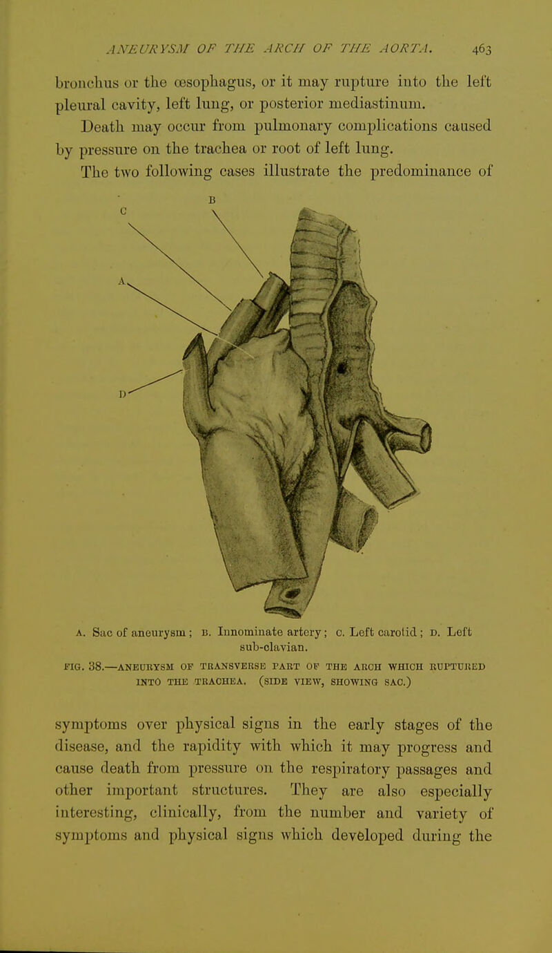 bronchus or the oesophagus, or it may rupture into the left pleural cavity, left lung, or posterior mediastinum. Death may occur from pulmonary complications caused by pressure on the trachea or root of left lung. The two following cases illustrate the predominance of sub-olavian. FIG. 38.—ANEURYSM OF TRANSVERSE PART OF THE ARCH WHICH RUPTURED INTO THE TRACHEA. (SIDE VIEW, SHOWING SAC.) symptoms over physical signs in the early stages of the disease, and the rapidity with which it may progress and cause death from pressure on the respiratory passages and other important structures. They are also especially interesting, clinically, from the number and variety of symptoms and physical signs which developed during the