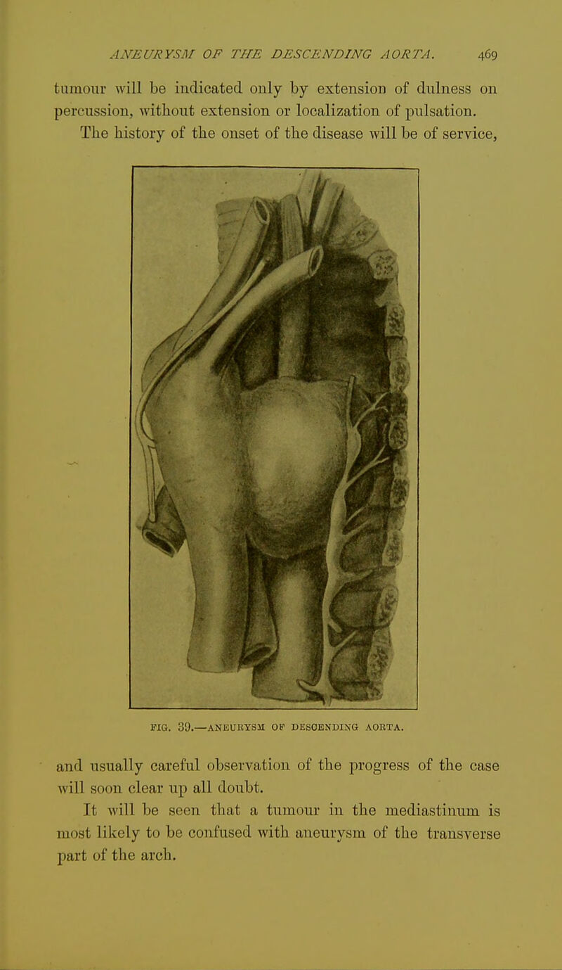 tumoiir will be indicated only by extension of dulness on percussion, without extension or localization of pulsation. The history of the onset of the disease will be of service, FIG. 30.—ANEURYSM OP DESCENDING AOBTA. and usually careful observation of the progress of the case will soon clear up all doiibt. It will be seen that a tumour in the mediastinum is most likely to be confused with aneurysm of the transverse part of the arch.