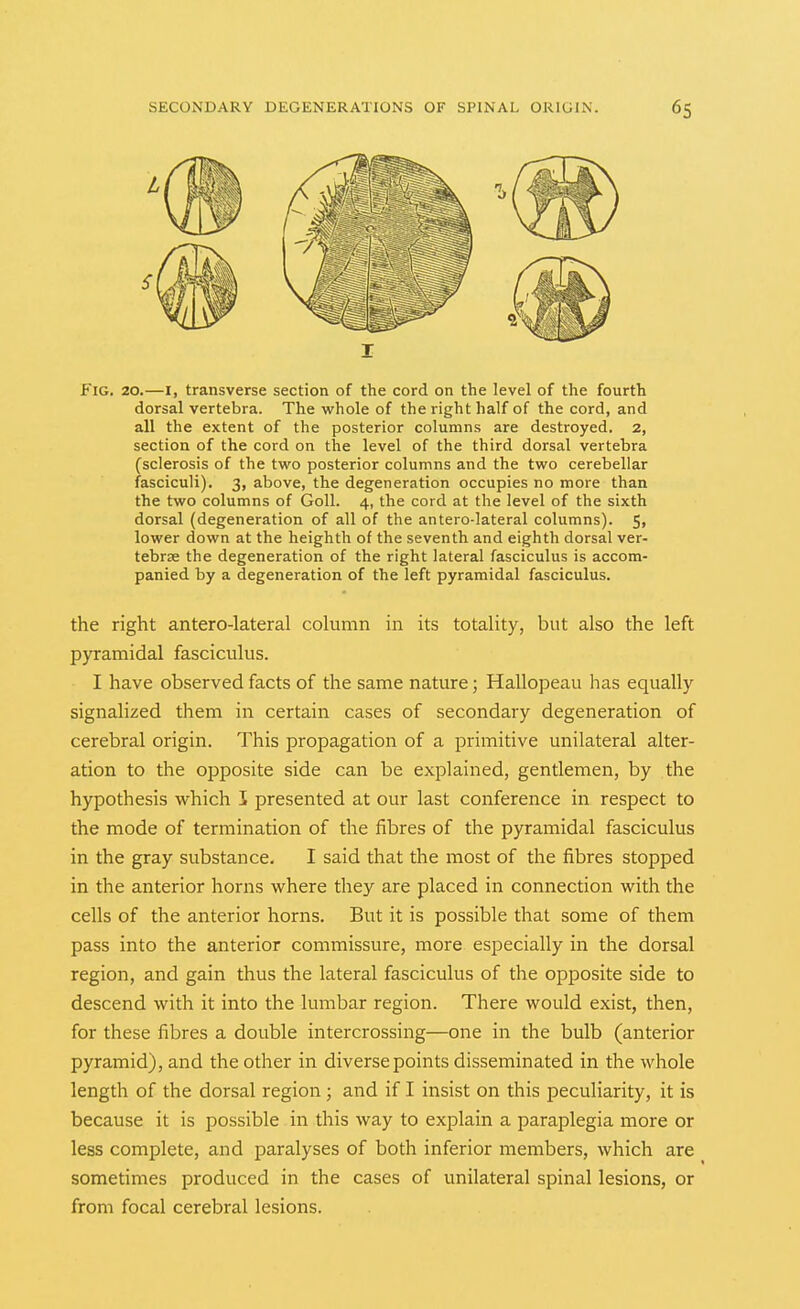 Fig. 20.—I, transverse section of the cord on the level of the fourth dorsal vertebra. The whole of the right half of the cord, and all the extent of the posterior columns are destroyed. 2, section of the cord on the level of the third dorsal vertebra (sclerosis of the two posterior columns and the two cerebellar fasciculi). 3, above, the degeneration occupies no more than the two columns of GoU. 4, the cord at the level of the sixth dorsal (degeneration of all of the antero-lateral columns). 5, lower down at the heighth of the seventh and eighth dorsal ver- tebrae the degeneration of the right lateral fasciculus is accom- panied by a degeneration of the left pyramidal fasciculus. the right antero-lateral column in its totality, but also the left pyramidal fasciculus. I have observed facts of the same nature; Hallopeau has equally signalized them in certain cases of secondary degeneration of cerebral origin. This propagation of a primitive unilateral alter- ation to the opposite side can be explained, gentlemen, by the hypothesis which I presented at our last conference in respect to the mode of termination of the fibres of the pyramidal fasciculus in the gray substance. I said that the most of the fibres stopped in the anterior horns where they are placed in connection with the cells of the anterior horns. But it is possible that some of them pass into the anterior commissure, more especially in the dorsal region, and gain thus the lateral fasciculus of the opposite side to descend with it into the lumbar region. There would exist, then, for these fibres a double intercrossing—one in the bulb (anterior pyramid), and the other in diverse points disseminated in the whole length of the dorsal region; and if I insist on this peculiarity, it is because it is possible in this way to explain a paraplegia more or less complete, and paralyses of both inferior members, which are sometimes produced in the cases of unilateral spinal lesions, or from focal cerebral lesions.