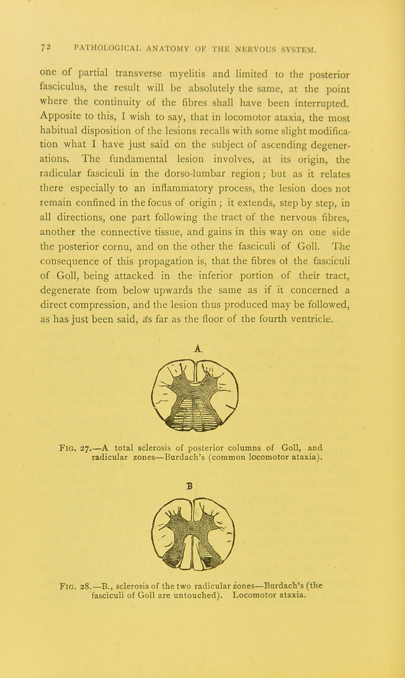 one of partial transverse myelitis and limited to the posterior fasciculus, the result will be absolutely the same, at the point where the continuity of the fibres shall have been interrupted. Apposite to this, I wish to say, that in locomotor ataxia, the most habitual disposition of tlie lesions recalls with some slight modifica- tion what I have just said on the subject of ascending degener- ations. The fundamental lesion involves, at its origin, the radicular fasciculi in the dorso-lumbar region; but as it relates there especially to an inflammatory process, the lesion does not remain confined in the focus of origin ; it extends, step by step, in all directions, one part following the tract of the nervous fibres, another the connective tissue, and gains in this way on one side the posterior cornu, and on the other the fasciculi of Goll. The consequence of this propagation is, that the fibres ot the fasciculi of Goll, being attacked in the inferior portion of their tract, degenerate from below upwards the same as if it concerned a direct compression, and the lesion thus produced may be followed, as has just been said, ats far as the floor of the fourth ventricle. A. Fig. 27.—total sclerosis of posterior columns of Goll, and radicular zones—Burdach's (common locomotor ataxia). 3 Fig. 28.—B., sclerosis of the two radicular zones—Burdach's (the fasciculi of Goll are untouched). Locomotor ataxia.