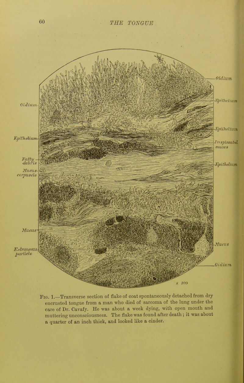 Oidiuui Epithelium Fatty debris Mucus corpuscle Mucus Extraneous jjarticle ~ Oidiutn ffiK -A-tyith<lmm -Epithelium ^-^ITii spiasa toi mucus -Epithelium ■Mucus Oidium x 300 Fig. 1.—Transverse section of flake of coat spontaneously detached from dry encrusted tongue from a man who died of sarcoma of the lung under the care of Dr. Cavafy. He was about a week dying, with open mouth and muttering unconsciousness. The flake was found after death; it was about a quarter of an inch thick, and looked like a cinder.