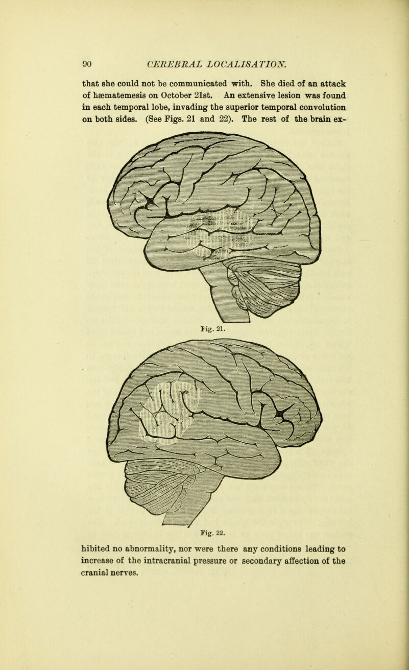 that she could not be communicated with. She died of an attack of hsematemesis on October 21st. An extensive lesion was found in each temporal lobe, invading the superior temporal convolution on both sides. (See Figs. 21 and 22). The rest of the brain ex- Fig. 22. hibited no abnormality, nor were there any conditions leading to increase of the intracranial pressure or secondary affection of the cranial nerves.