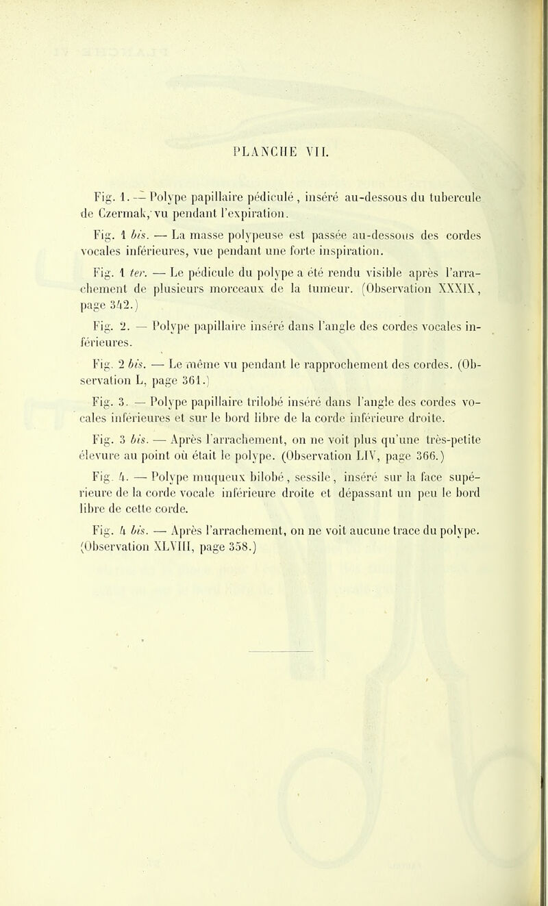 PLANCHE VII. Fig. 1. -— Polype papillaire pédicule , inséré au-dessous du tubercule de Czermak, vu pendant l'expiration. Fig. 1 bis. — La masse polypeuse est passée au-dessous des cordes vocales inférieures, vue pendant une forte inspiration. Fig. 1 te?\ — Le pédicule du polype a été rendu visible après l'arra- cbement de plusieurs morceaux de la tumeur. (Observation XXXIX, page 3/(2.) Fig. 2. — Polype papillaire inséré dans l'angle des cordes vocales in- férieures. Fig. 2 bis. — Le même vu pendant le rapprochement des cordes. (Ob- servation L, page 361.) Fig. 3. — Polype papillaire trilobé inséré dans l'angle des cordes vo- cales inférieures et sur le bord libre de la corde inférieure droite. Fig. 3 bis. — Après l'arrachement, on ne voit plus qu'une très-petite élevure au point où était le polype. (Observation LIV, page 366.) Fig. U. — Polype muqueux bilobé , sessile , inséré sur la face supé- rieure de la corde vocale inférieure droite et dépassant un peu le bord libre de cette corde. Fig. k bis. — Après l'arrachement, on ne voit aucune trace du polype. (Observation XLVIII, page 358.)