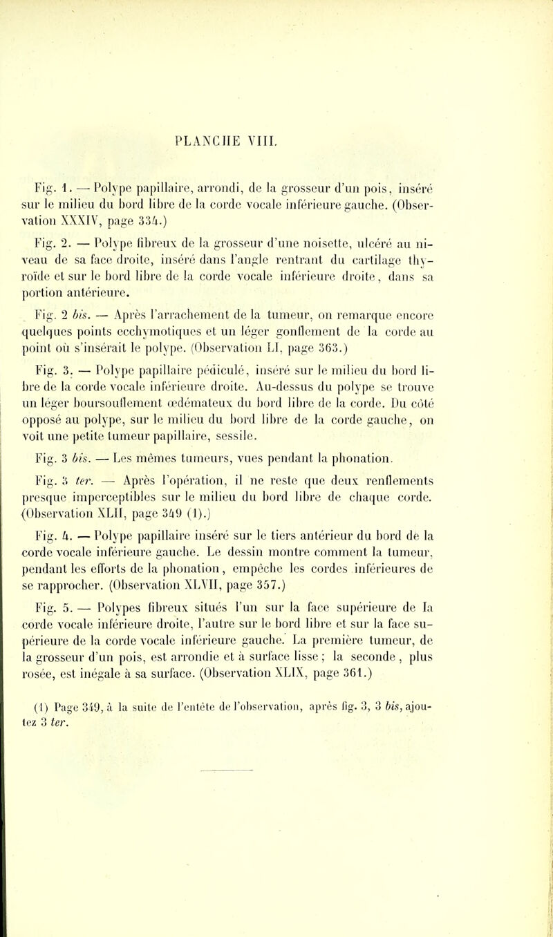 Fig. 1. — Polype papillaire, arrondi, de la grosseur d'un pois, inséré sur le milieu du bord libre de la corde vocale inférieure gauche. (Obser- vation XXXIV, page 33/i.) Fig. 2. — Polype fibreux de la grosseur d'une noisette, ulcéré au ni- veau de sa face droite, inséré dans l'angle rentrant du cartilage thy- roïde et sur le bord libre de la corde vocale inférieure droite, dans sa portion antérieure. Fig. 2 bis. — Après l'arrachement de la tumeur, on l'emarque encore quelques points ecchymotiqucs et un léger gonflement de la corde au point où s'insérait le polype. (Observation Ll. page 3(5.3.) Fig. 3. — Polype papillaire pédiculé, inséré sur le milieu du bord li- bre de la corde vocale inférieure droite. Au-dessus du polype se trouve un léger boursouflement œdémateux du bord libre de la corde. Du côté opposé au polype, sur le milieu du bord libre de la corde gauche, on voit une petite tumeur papillaire, sessile. Fig. 3 bis. — Les mêmes tumeui's, vues pendant la phonation. Fig. 3 ter. — Après l'opération, il ne reste que deux renflements presque imperceptibles sur le milieu du bord libre de chaque corde. (Observation XLII, page 3^19 (1).) Fig. h. — Polype papillaire inséré sur le tiers antérieur du bord de la corde vocale inférieure gauche. Le dessin montre comment la tumeur, pendant les efforts de la phonation, empêche les cordes inférieures de se rapprocher. (Observation XLVII, page 357.) Fig. 5. — Polypes fibreux situés l'un sur la face supérieure de La corde vocale inférieure droite, l'autre sur le bord libre et sur la face su- périeure de la corde vocale inférieure gauche. La première tumeur, de la grosseur d'un pois, est arrondie et h. surface lisse ; la seconde , plus rosée, est inégale à sa surface. (Observation XLIX, page 361.) (I) Page 349, à la suite de l'entête di! l'o])servafioii, après fig. 3, 3 bis, ajou- tez 3 ter.