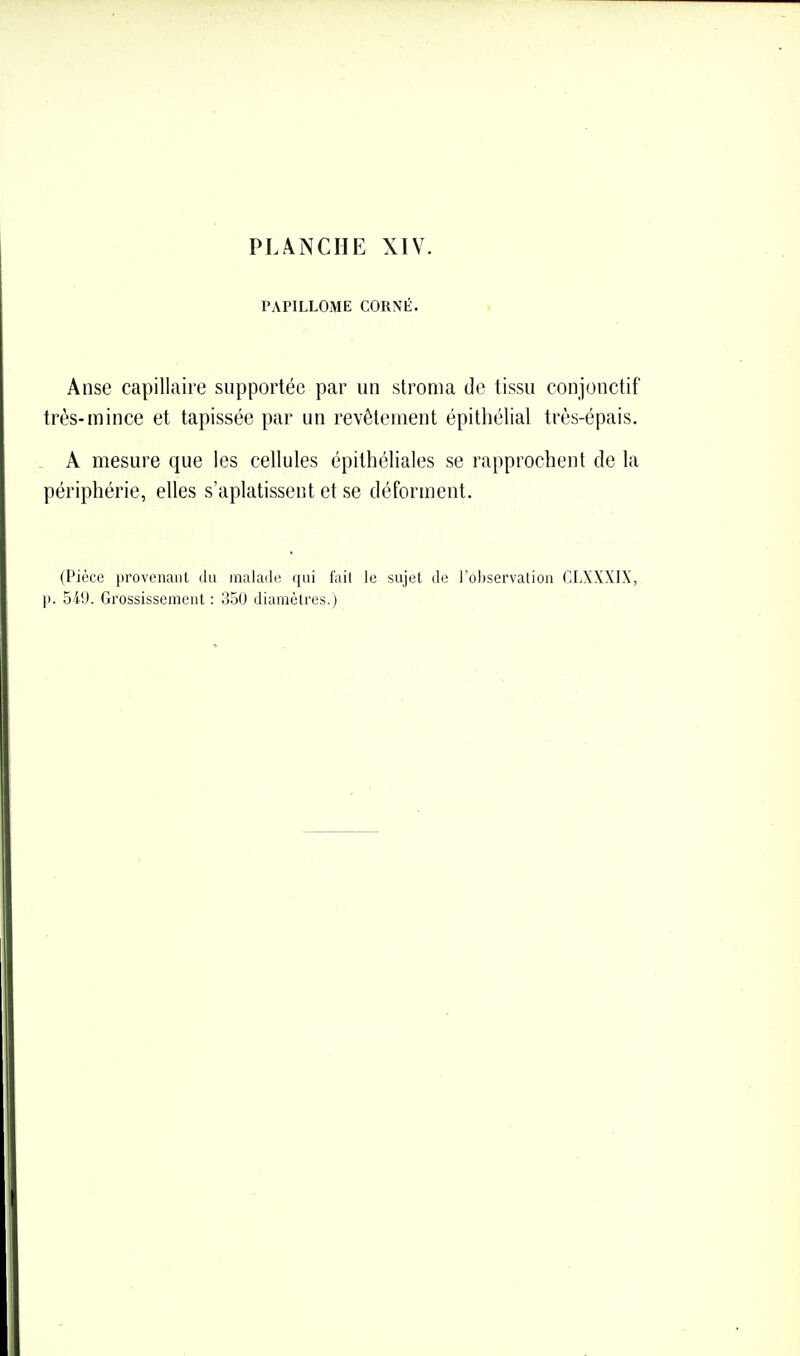 PAPILLOME CORNÉ. Anse capillaire supportée par un stroma de tissu conjonctif très-mince et tapissée par un revêtement épithélial très-épais. A mesure que les cellules épithéliales se rapprochent de la périphérie, elles s'aplatissent et se déforment. (Pièce provenant du inalail(; qui fait le sujet de l'observation CLXXXIX,