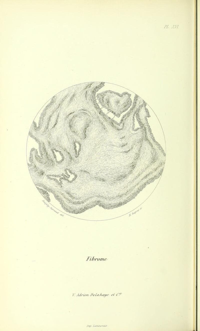 Fibrome/ VAdrieruDeLithia/e et Cf