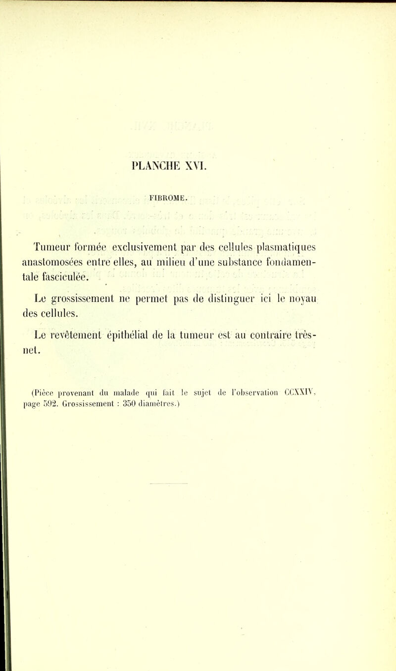 FIBROME. Tumeur formée exclusivement par des cellules plasmatiques anastomosées entre elles, au milieu d'une substance fondamen- tale fasciculée. Le grossissement ne permet pas de distinguer ici le noyau des cellules. Le revêtement épithélial de la tumeur est au contraire très- net.  ' (Pièce provenant lUi malade ([ui lait !e sujet de l'observation GCXXIV, page rj9!2. Grossissement : 350 diamètres.)