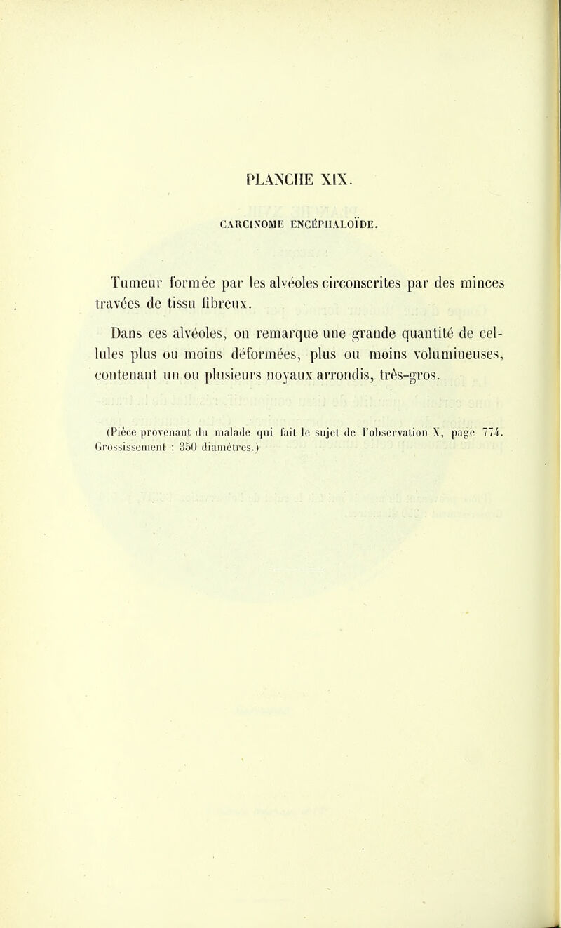 CARCINOME ENCÉPIIALOÏDE. Tumeur formée par les alvéoles circonscrites par des minces travées de tissu fibreux. Dans ces alvéoles, on remarque une grande quantité de cel- lules plus ou moins déformées, plus ou moins volumineuses, contenant nu ou plusieurs noyaux arrondis, très-gros. (Pièce provenant du malade qni lait le sujet de l'observation X, page 774.