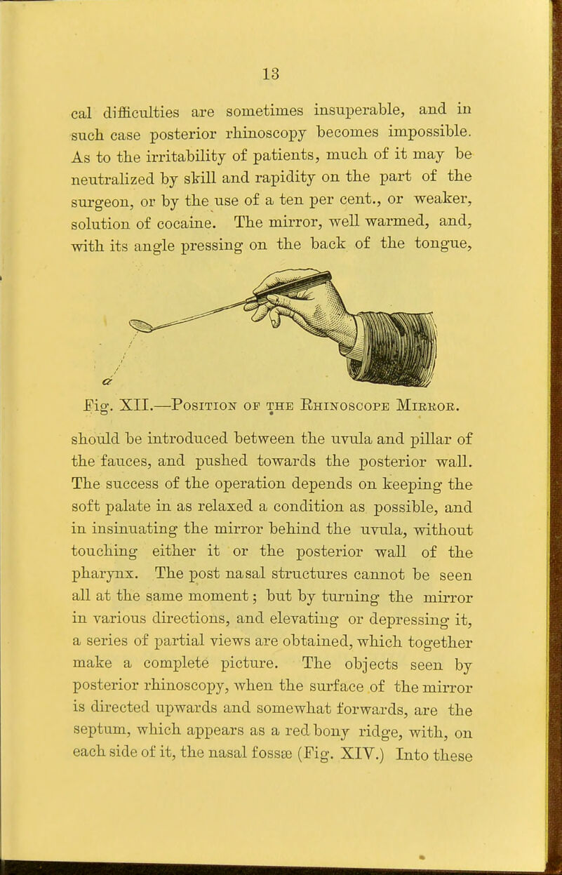 cal difficulties are sometimes insuperable, and in such case posterior rhinoscopy becomes impossible. As to the irritability of patients, much of it may be neutralized by still and rapidity on the part of the surgeon, or by the use of a ten per cent., or weaker, solution of cocaine. The mirror, well warmed, and, with its angle pressing on the back of the tongue. JB-ig. XII.—Position of the Ehinoscope Mirkoe. should be introduced between the uvula and pillar of the fauces, and pushed towards the posterior wall. The success of the operation depends on keeping the soft palate in as relaxed a condition as possible, and in insinuating the mirror behind the uvula, without touching either it or the posterior wall of the pharynx. The post nasal structures cannot be seen all at the same moment; but by turning the mirror in various directions, and elevating or depressing it, a series of partial views are obtained, which together make a complete picture. The objects seen by posterior rhinoscopy, when the surface of the mirror is directed upwards and somewhat forwards, are the septum, which appears as a red bony ridge, with, on each side of it, the nasal f ossse (Fig. XIV.) Into these