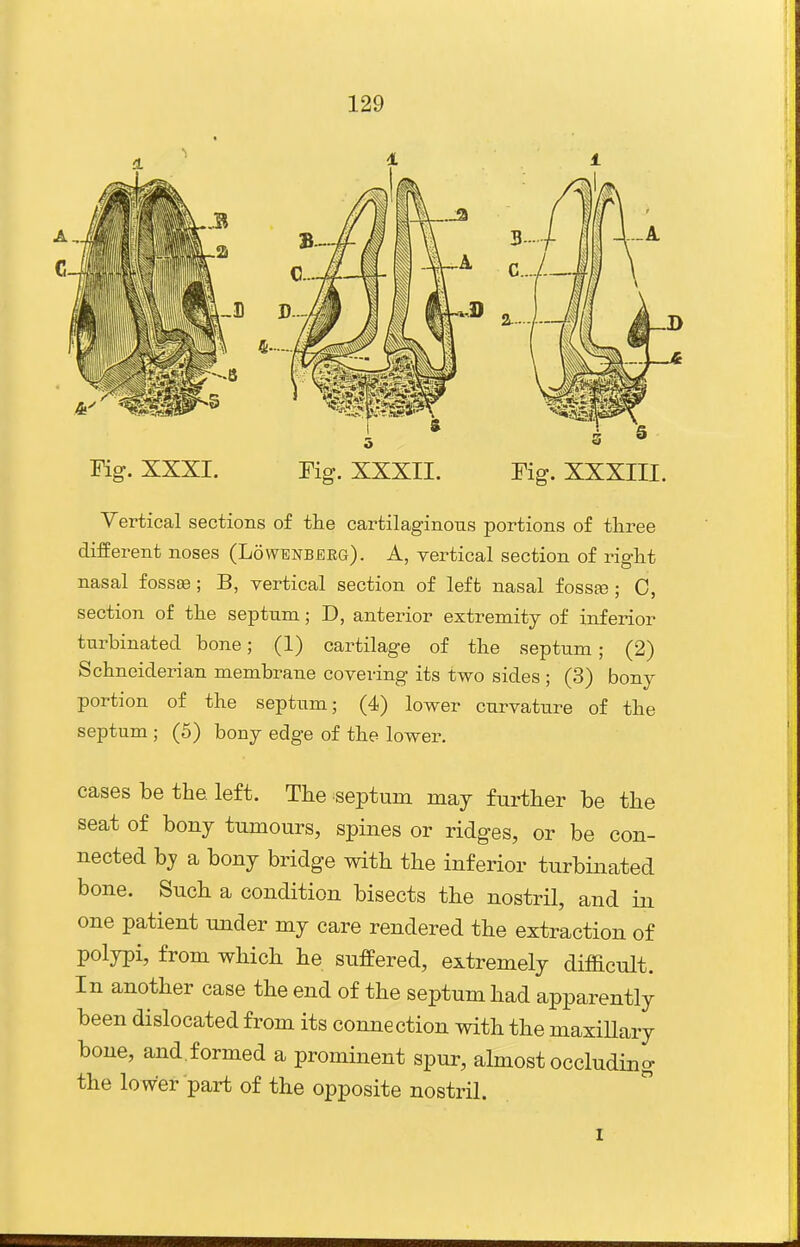 Vertical sections of the cartilaginous portions o£ three different noses (Lowenberg). A, vertical section of right nasal foss^; B, vertical section of left nasal fossa?; C, section of the septum; D, anterior extremity of inferior turbinated bone; (1) cartilage of the septum; (2) Schneiderian membrane covering its two sides; (3) bony portion of the septum; (4) lower curvature of the septum ; (5) bony edge of the lower. cases be the. left. The septum may further be the seat of bony tumours, spines or ridges, or be con- nected by a bony bridge with the inferior turbinated bone. Such a condition bisects the nostril, and in one patient under my care rendered the extraction of polypi, from which he suffered, extremely difficult. In another case the end of the septum had apparently been dislocated from its connection with the maxiUary bone, and formed a prominent spur, almost occluding the lower part of the opposite nostril. I