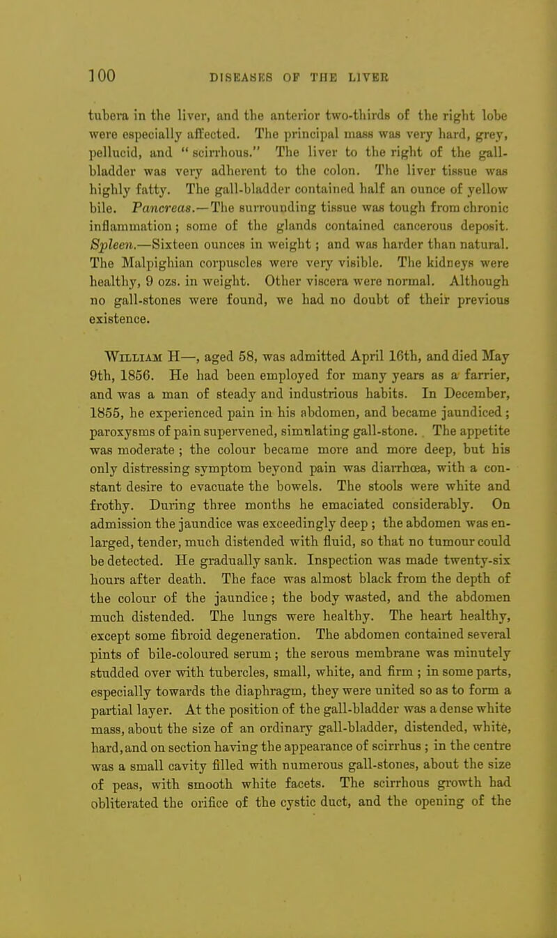 tubora in the liver, and the anterior two-tliirds of the right lobe were especially affected. The principal mass was very hard, grej', pellucid, and  scirrhous. The liver to the right of the gall- bladder was very adherent to the colon. The liver tissue was highly fatty. The gall-bladder contained half an ounce of yellow bile. Pancreaa.—The surrounding tissue waa tough from chronic inflammation; some of the glands contained cancerous deposit. Spleen.—Sixteen ounces in weight; and was harder than natural. The Malpighian corpuscles were very visible. The kidneys were healthy, 9 ozs. in weight. Other viscera were normal. Although no gall-stones were found, we had no doubt of their previous existence. William H—, aged 58, was admitted April 16th, and died May 9th, 1856. He had been employed for many years as a farrier, and was a man of steady and industrious habits. In December, 1855, he experienced pain in his abdomen, and became jaundiced ; paroxysms of pain supervened, simulating gall-stone.. The appetite was moderate ; the colour became more and more deep, but his only distressing symptom beyond pain was diarrhoea, with a con- stant desire to evacuate the bowels. The stools were white and frothy. During three months he emaciated considerably. On admission the jaundice was exceedingly deep ; the abdomen was en- larged, tender, much distended with fluid, so that no tumour could be detected. He gradually sank. Inspection was made twenty-six liours after death. The face was almost black from the depth of the colour of the jaundice; the body wasted, and the abdomen much distended. The lungs were healthy. The heart healthy, except some fibroid degeneration. The abdomen contained several pints of bile-coloured serum; the serous membrane was minutely studded over with tubercles, small, white, and firm ; in some parts, especially towards the diaphragm, they were united so as to form a partial layer. At the position of the gall-bladder was a dense white mass, about the size of an ordinary gall-bladder, distended, white, hard, and on section having the appearance of scirrhus ; in the centre was a small cavity filled with numerous gall-stones, about the size of peas, with smooth white facets. The scirrhous growth had obliterated the orifice of the cystic duct, and the opening of the