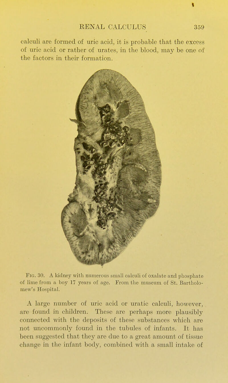 t RENAL CALCULUS 359 calculi are formed of uric acid, it is probable that the excess of i;ric acid or rather of urates, in the blood, may be one of the factors in their formation. Fig. 30. A kidney with numerous small calculi of oxalate and phosphate of lime from a boy 17 years of age. From the museum of St. Bartholo- mew's Hospital. A large number of uric acid or uratic calculi, however, are found in children. These are perhaps more plausibly connected with the deposits of these substances which are not uncommonly found in the tubules of infants. It has been suggested that they are due to a great amount of tissue change in the infant body, combined with a small intake of