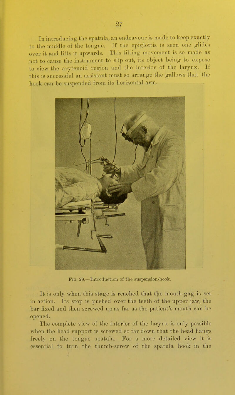 In introflncing the spatula, an endeavour is made to keep exactly to the middle of the tongue. If the epiglottis is seen one glides over it and lifts it upwards. This tilting movement is so made as not to cause the instrument to slip out, its object being to expose to view the arytenoid region and the interior of the larynx. If this is successful an assistant must so arrange the gallows that the hook can be suspended from its horizontal arm. Fig. 29.—Introduction of the suspension-liook. It is only when this stage is reached that tl;ie mouth-gag is set in action. Its stop is pushed over the teeth of the upper jaw, the bar fixed and then screwed up as far as the patient's mouth can be opened. The complete view of the interior of the larynx is only possible when the head support is screwed so far down that the head hangs freely on the tongue spatula. For a more detailed view it is essential to turn the thumb-screw of the spatula hook in the