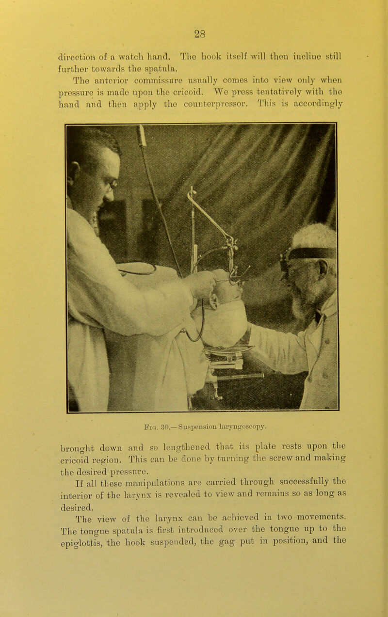 direction of a watch hand. The hook itself will then incline still further towards the spatula. The anterior commissure usually comes into view oidj' when pi'essure is made upon the cricoid. We press tentatively with the hand and then apply the counterpressor. This is accordingly Firt. 30.— Suspension laryngoscopy. brought down and so lengthened that its plate rests upon the cricoid region. This can be done by turning the screw and making the desired pressure. If all these manipulations are carried through successfully the interior of the larynx is revealed to view and remains so as long as desired. The view of the larynx can be achieved in two movements. The tongue spatula is first introduced over the tongue up to the epiglottis, the hook suspended, the gag put in position, and the