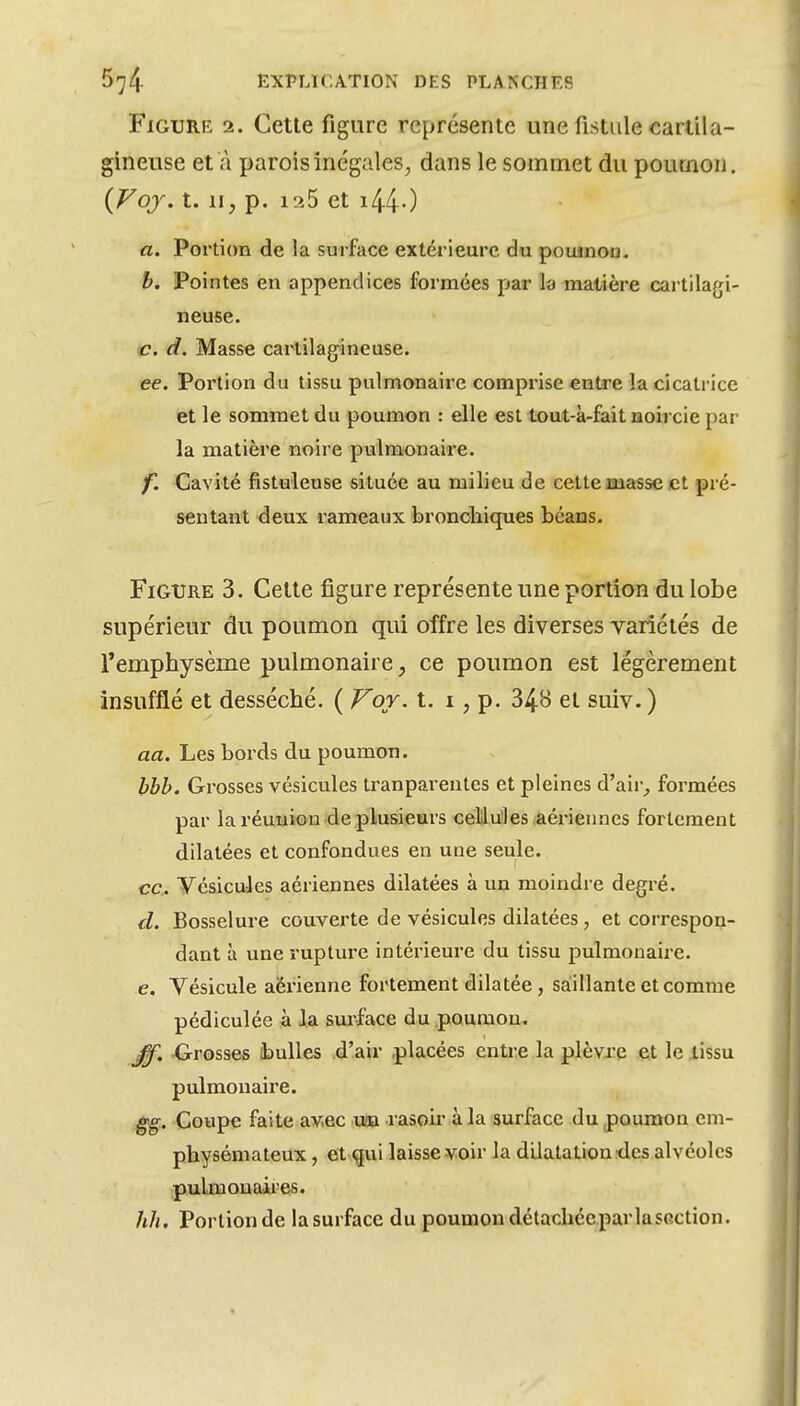 Figure 2. Cette figure représente une fistule cartila- gineuse et à parois inégales, dans le sommet du poumon. {Voj. t. II, p. 125 et i44-) a. Portion de la surface extérieure du pouinoo. b. Pointes en appendices formées par la matière cartilagi- neuse. <c. d. Masse cai'tilagineuse. ee. Portion du tissu pulmonaire comprise entre la cicatrice et le sommet du poumon : elle est tout-à-fait noircie par la matière noire pulmonaire. f. Cavité fistuleuse située au milieu de cette masse et pré- sentant deux rameaux broncliiques béans. Figure 3. Cette figure représente une portion du lobe supérieur du poumon qui offre les diverses variétés de Temphysème pulmonaire, ce poumon est légèrement insufflé et desséché. ( Voy. t. i, p. 34B et suiv. ) aa. Les bords du poumon. bbh. Grosses vésicules tranparentes et pleines d'aii-^ formées par la réunion de plusieurs ceMu'les aérieimes fortement dilatées et confondues en une seule. ce. yésicuJes aériennes dilatées à un moindre degré. d. Bosselure couverte de vésicules dilatées, et correspon- dant à une rupture intérieure du tissu pulmonaire. e. Vésicule aérienne fortement dilatée , saiillante et comme pédiculée à la surface du poumon. Grosses ibulles d'air .placées entre la plèvre et le tissu pulmonaire. gg. Coupe faite av.ec xm rasoir à la surface du poumon em- physémateux , et qui laisse-voir la dilatation des alvéoles pulmonaires. hh. Portion de lasurface du poumon détachécparlasGction.