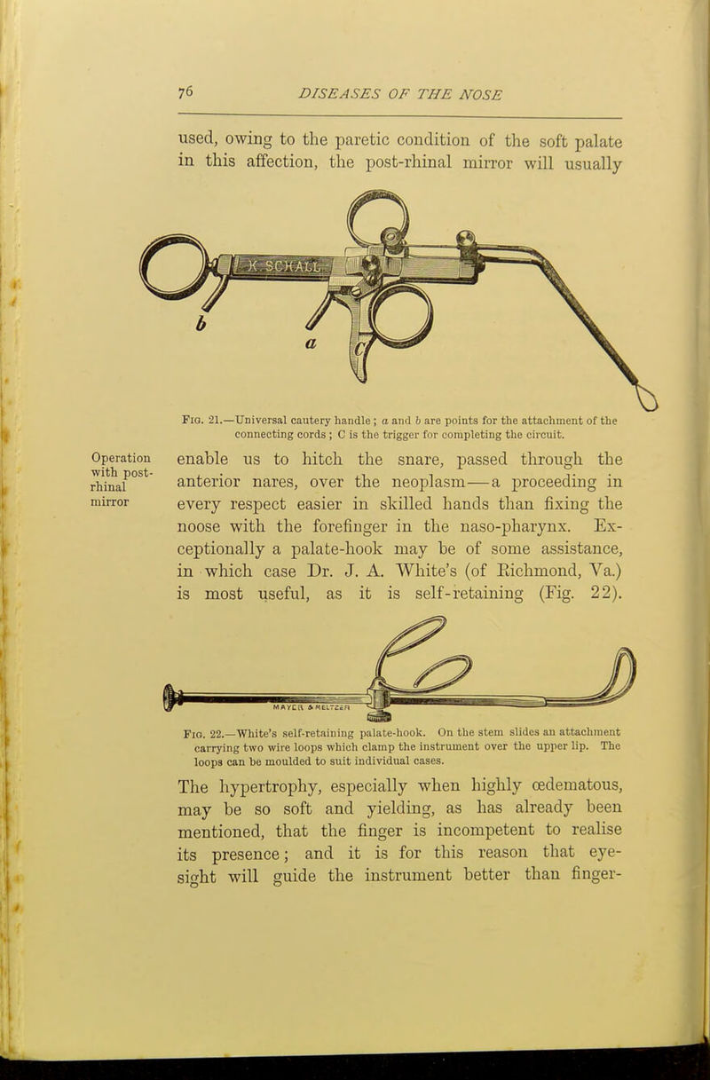 used, owing to the paretic condition of the soft palate in this affection, the post-rhinal mirror will usually FiQ. 21.—Universal cautery handle ; a and b are points for the attachment of the connecting cords ; C is the trigger for completing the circuit. Operation enable US to hitch the snare, passed through the with post- , ■ J.1 1 J- • rhinai anterior nares, over the neoplasm—a proceeding m mirror every respect easier in skilled hands than fixing the noose with the forefinger in the naso-pharynx. Ex- ceptionally a palate-hook may be of some assistance, in which case Dr. J. A. White's (of Eichmond, Va.) is most useful, as it is self-retaining (Fig. 22). Fio. 22.—White's self-retaining palate-hook. On the stem slides an attachment carrying two wire loops which clamp the instrument over the upper lip. The loops can he moulded to suit individual cases. The hypertrophy, especially when highly oedematous, may be so soft and yielding, as has already been mentioned, that the finger is incompetent to realise its presence; and it is for this reason that eye- sight will guide the instrument better than finger-