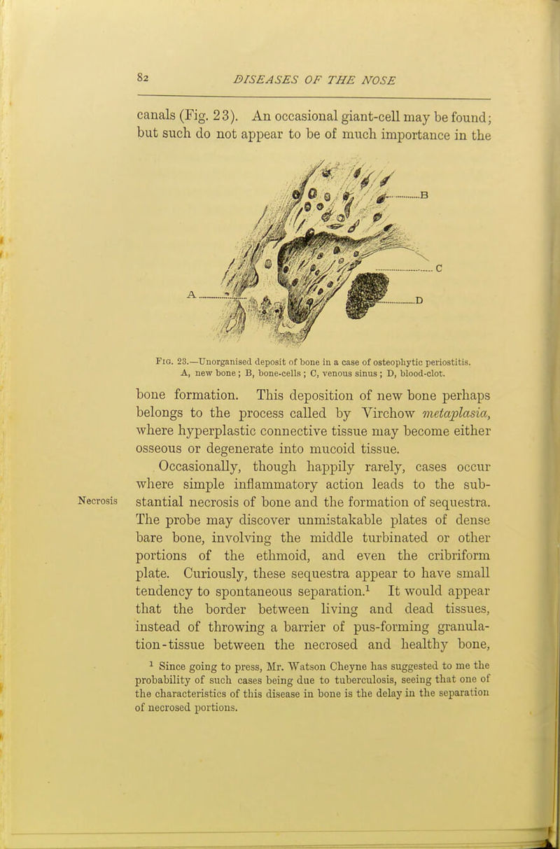 canals (Fig. 23). An occasional giant-cell may be found; but such do not appear to be of much importance in the Fig. 23.—Unorganised deposit of bone in a case of osteophytic periostitis. A, new bone ; B, bone-cells ; C, venous sinus ; D, blood-clot. bone formation. This deposition of new bone perhaps belongs to the process called by Virchow meiajjlasia, where hyperplastic connective tissue may become either osseous or degenerate into mucoid tissue. . Occasionally, though happily rarely, cases occur where simple inflammatory action leads to the sub- Necrosis stantial necrosis of bone and the formation of sequestra. The probe may discover unmistakable plates of dense bare bone, involving the middle turbinated or other portions of the ethmoid, and even the cribriform plate. Curiously, these sequestra appear to have small tendency to spontaneous separation.^ It would appear that the border between living and dead tissues, instead of throwing a barrier of pus-forming granula- tion-tissue between the necrosed and healthy bone, ^ Since going to press, Mr. Watson Cheyne has suggested to me the probability of such cases being due to tuberculosis, seeing that one of the characteristics of this disease in bone is the delay in the separation of necrosed portions.