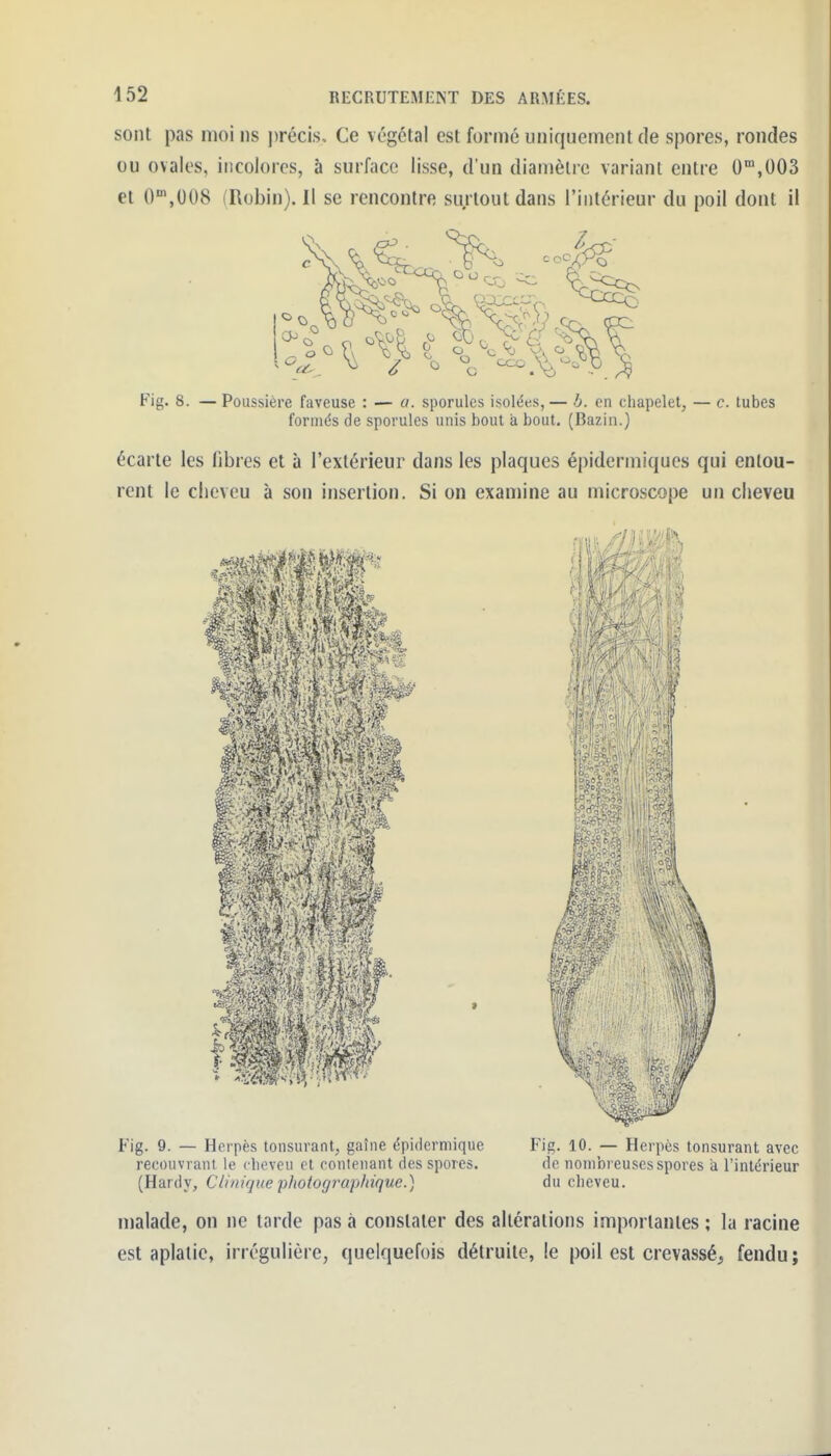 sont pas moi iis iirécis. Ce végétal est formé uniquement de spores, rondes ou ovales, incolores, à surface lisse, d'un diamètre variant entre 0'°,003 et O^.OOS (Robin). Il se rencontre surtout dans l'intérieur du poil dont il Fig. 8. — Poussière faveuse : — «. sporules isolées,— h. en chapelet, — c. tubes formés de sporules unis bout à bout. (Bazin.) écarte les fibres et à l'extérieur dans les plaques épidermiques qui entou- rent le cheveu à son insertion. Si on examine au microscope un cheveu Fig. 9. — Herpès tonsurant, gaîiie épidermique recouvrant le clieveu et contenant des spores. (Hardy, Clinique -photographique.) ni Fig. 10. — Herpès tonsurant avec de nombreuses spores a l'intérieur du cheveu. malade, on ne tarde pas à constater des altérations importantes ; la racine est aplatie, irrégulière, quelquefois détruite, le poil est crevassé^ fendu;