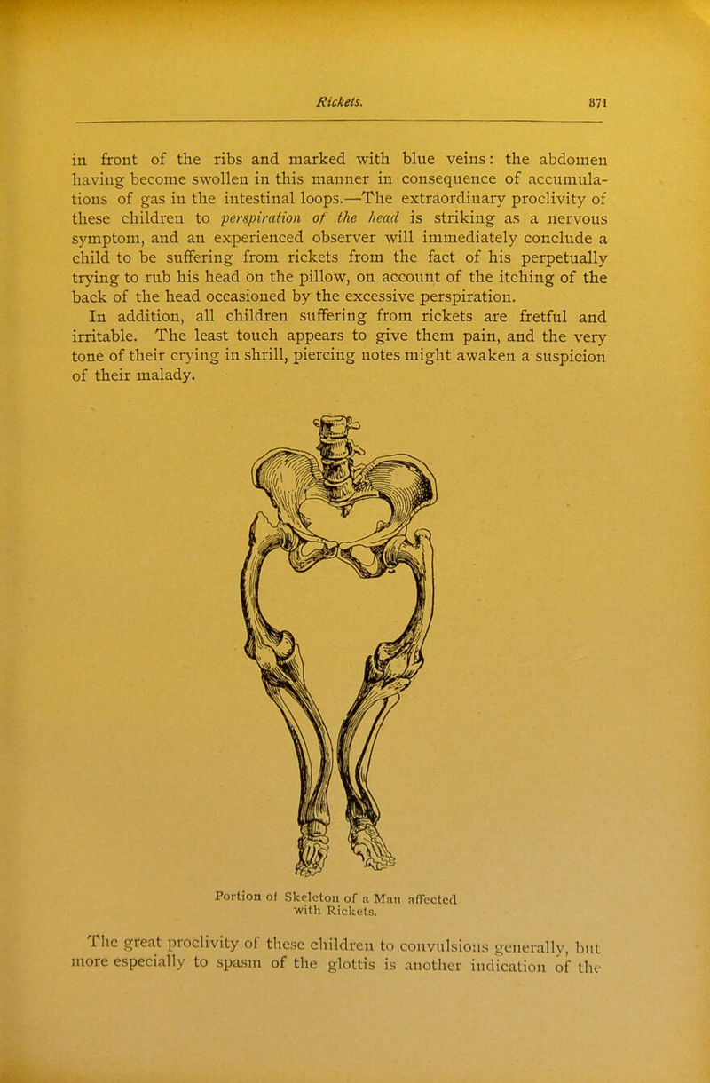 in front of the ribs and marked with blue veins: the abdomen having become swollen in this manner in consequence of accumula- tions of gas in the intestinal loops.—'The extraordinary proclivity of these children to perspiration of the head is striking as a nervous symptom, and an experienced observer will immediately conclude a child to be suffering from rickets from the fact of his perpetually trying to rub his head on the pillow, on account of the itching of the back of the head occasioned by the excessive perspiration. In addition, all children suffering from rickets are fretful and irritable. The least touch appears to give them pain, and the very tone of their crying in shrill, piercing notes might awaken a suspicion of their malady. Portion ol Skcletou of a Man alTected with Rickets. Tlic great proclivity of these children to convulsions generally, but more especially to spasm of the glottis is another indication of the