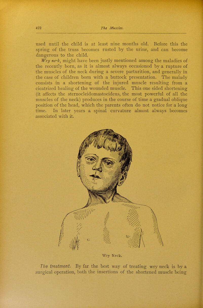 used until the child is at least nine months old. Before this the spring of the truss becomes rusted by the urine, and can become dangerous to the child. Wry nch, might have been justly mentioned among the maladies of the recently born, as it is almost always occasioned by a rupture of the muscles of the neck during a severe parturition, and generally in the case of children born with a buttock presentation. The malady consists in a shortening of the injured muscle resulting from a cicatrized healing of the wounded muscle. This one sided shortening (it affects the sternocleidomastoeideus, the most powerful of all the muscles of the neck) produces in the course of time a gradual oblique position of the head, which the parents often do not notice for a long time. In later years a spinal curvature almost always becomes associated with it. Wry Neck. The treatment. By far the best way of treating wry neck is by a surgical operation, both the insertions of the shortened muscle being