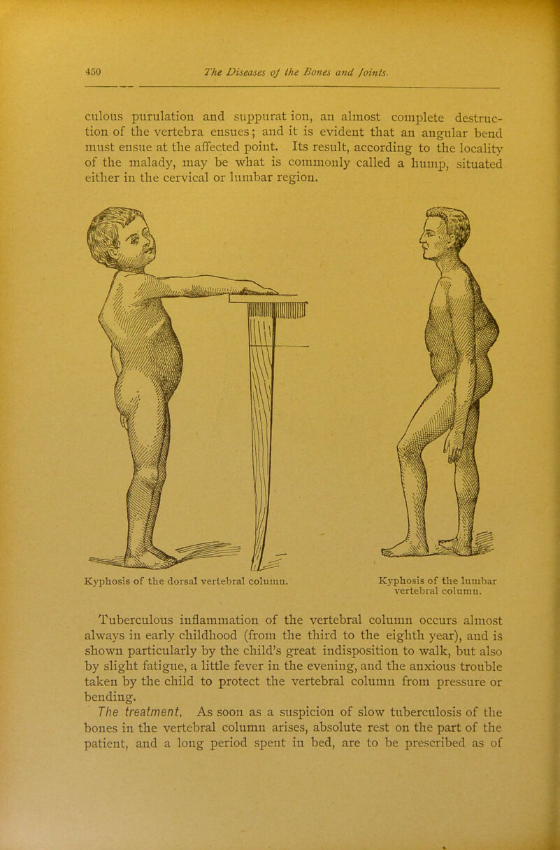 culous purulation and suppurat ion, an almost complete destruc- tion of the vertebra ensues; and it is evident that an angular bend must ensue at the affected point. Its result, according to the locality of the malady, may be what is commonly called a hump, situated either in the cervical or lumbar region. Kyphosis of the dorsal vertebral columu. Kyphosis of the lumbar vertebral coluuiu. Tuberculous inflammation of the vertebral column occurs almost always in early childhood (from the third to the eighth year), and is shown particularly by the child's great indisposition to walk, but also by slight fatigue, a little fever in the evening, and the anxious trouble taken by the child to protect the vertebral column from pressure or bending. The treatment, As soon as a suspicion of slow tuberculosis of the bones in the vertebral column arises, absolute rest on the part of the patient, and a long period spent in bed, are to be prescribed as of