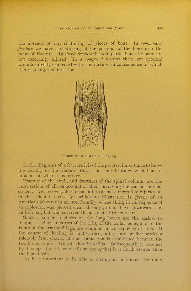 the absence of any shattering of pieces of bone. In comminuted fracture we have a shattering of the portions of the bone near the point of fracture. In simple fracture the soft parts about the bone are not externally injured. In a compound fracture there are external wounds directly connected with the fracture, in consequence of which there is danger of infection. Fracture iu a state of healing. In the diagnosis of a fracture it is of the greatest importance to know the locality of the fracture, that is not only to know what bone is broken, but where it is broken. Fracture of the skull, and fractures of the spinal column, are the most serious of all, on account of their involving the central nervous system. Yet recovery does ensue after the most incredible injuries, as in the celebrated case (of which an illustration is given) of an American labourer in an iron foundry, whose skull, in consequence of an explosion, was pierced clean through, from above downwards, by an iron bar, but who survived the accident thirteen years. Smooth simple fractures of the long bones are the easiest to diagnose. Such fractures of the ribs, of the collar bone, and of the bones of the arms and legs, are common in consequence of falls. If the course of healing is undisturbed, after four or five weeks a tolerably firm, elastic, fibrous connection is established between the two broken ends. We call this the callus. Subsequently it becomes by the deposition of bone cells so strong that it is much stouter than the bone itself. As it is important to be able to distinguish a fracture from any